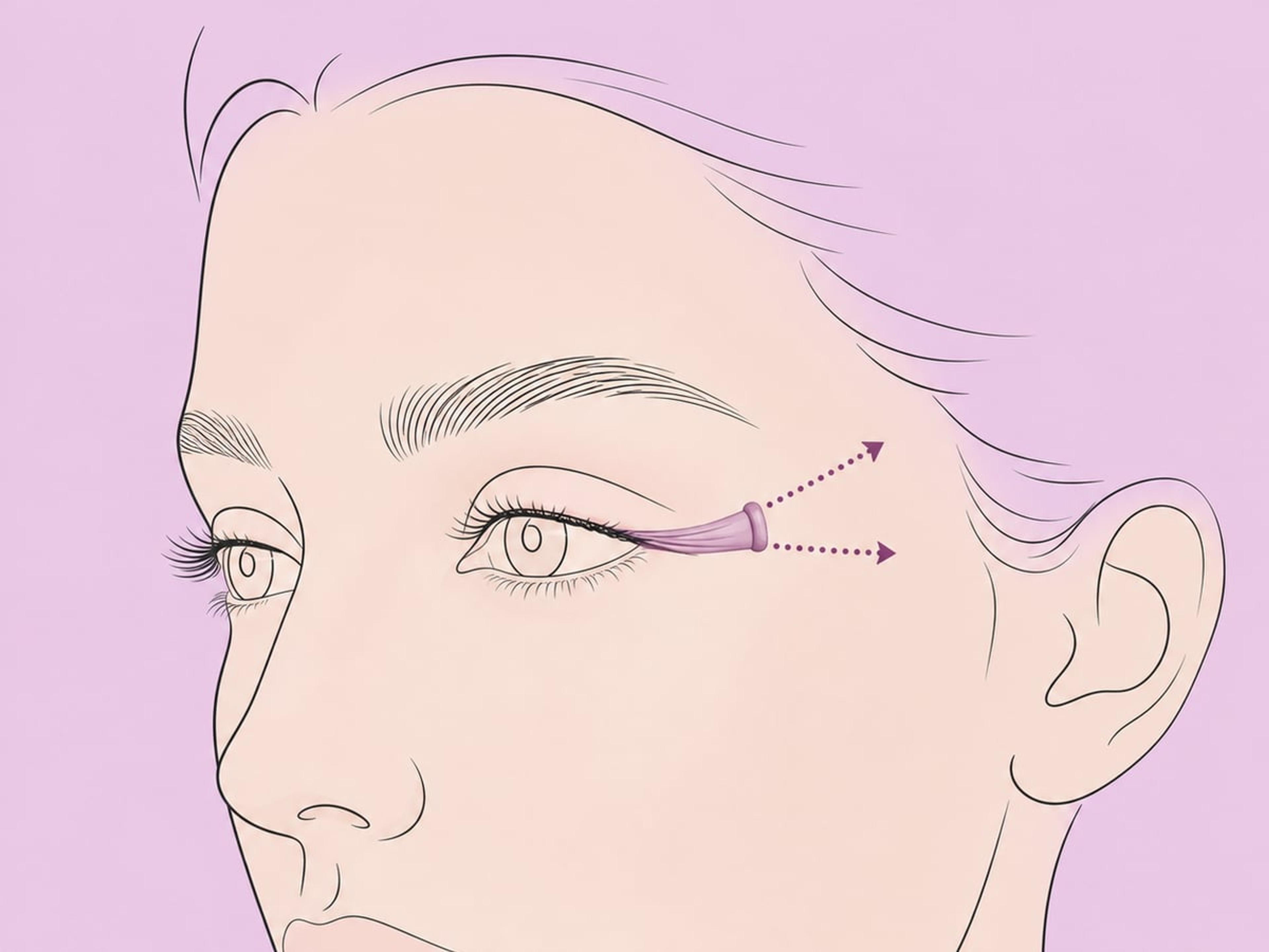Laterale Kanthoplastik — illustration