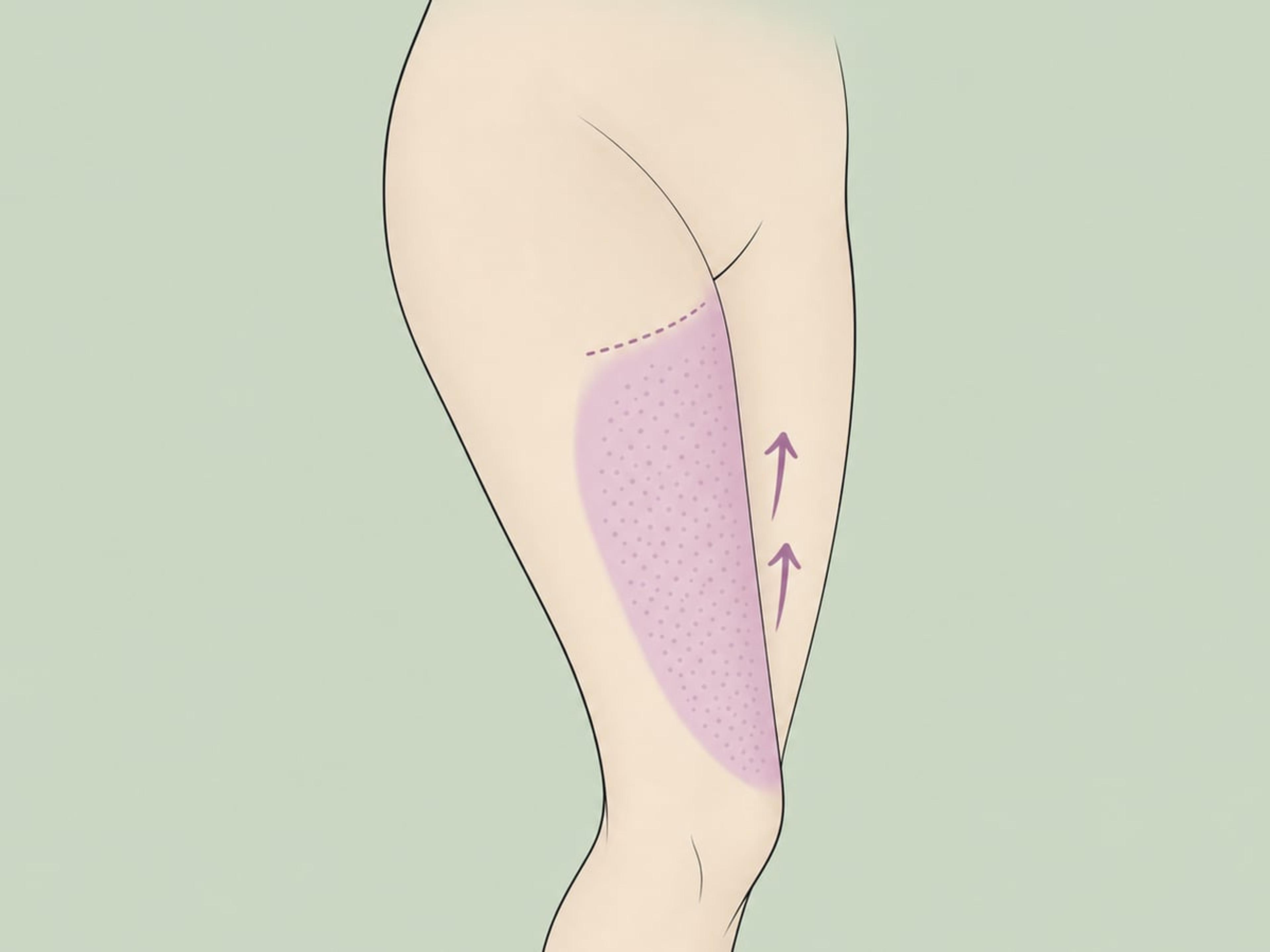 Lifting delle cosce con liposuzione assistita — illustration