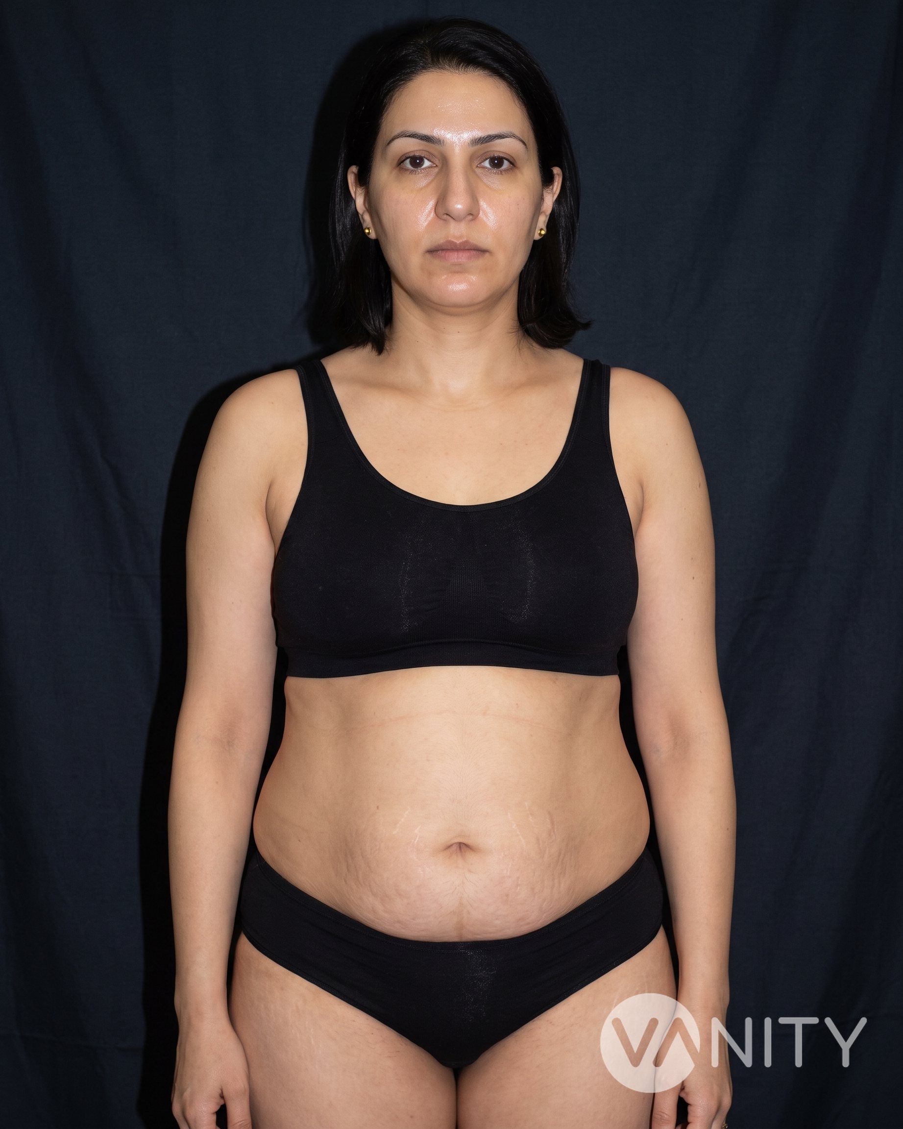 Before Mommy makeover — illustrative, not a real patient