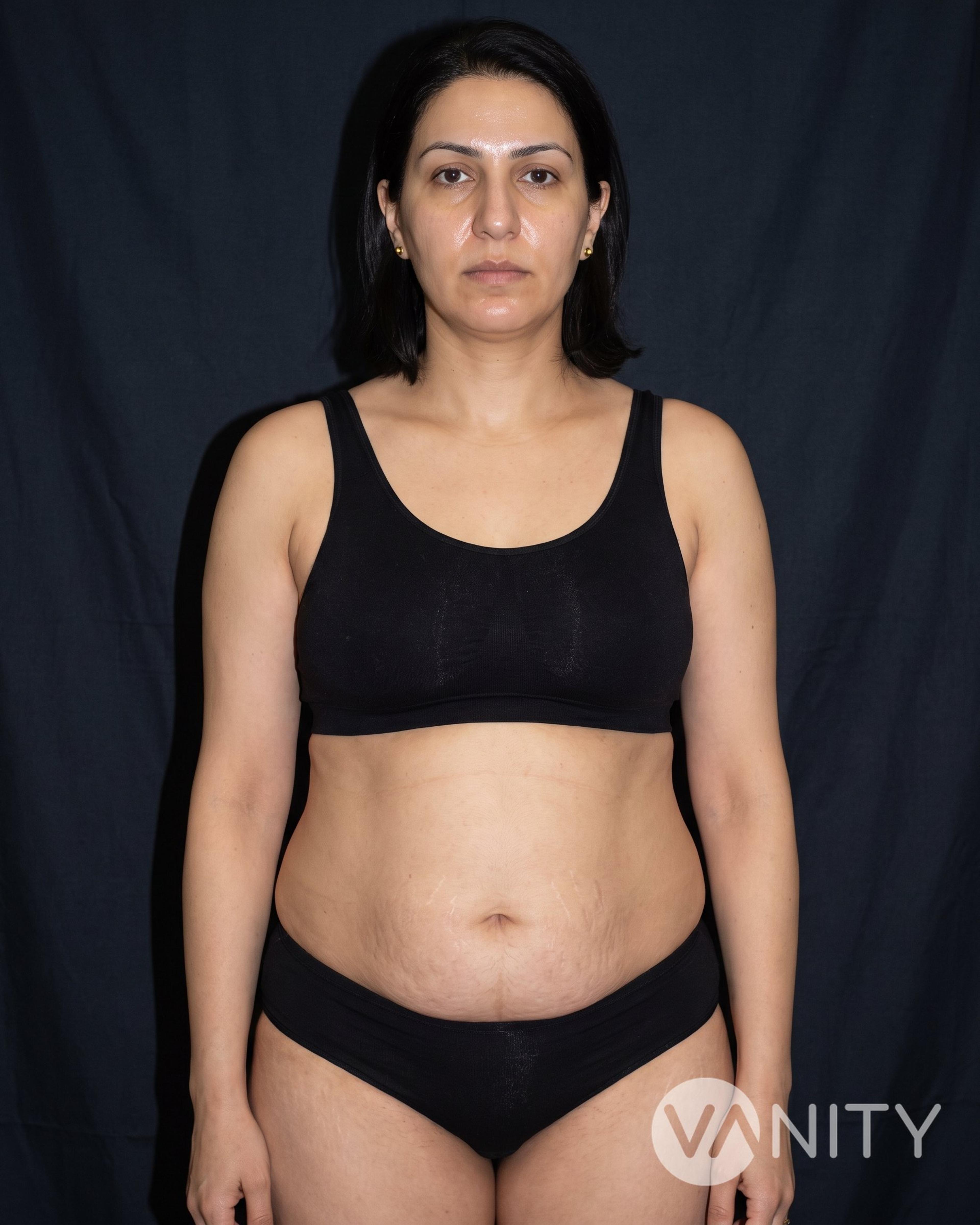 Before Mommy makeover — illustrative, not a real patient