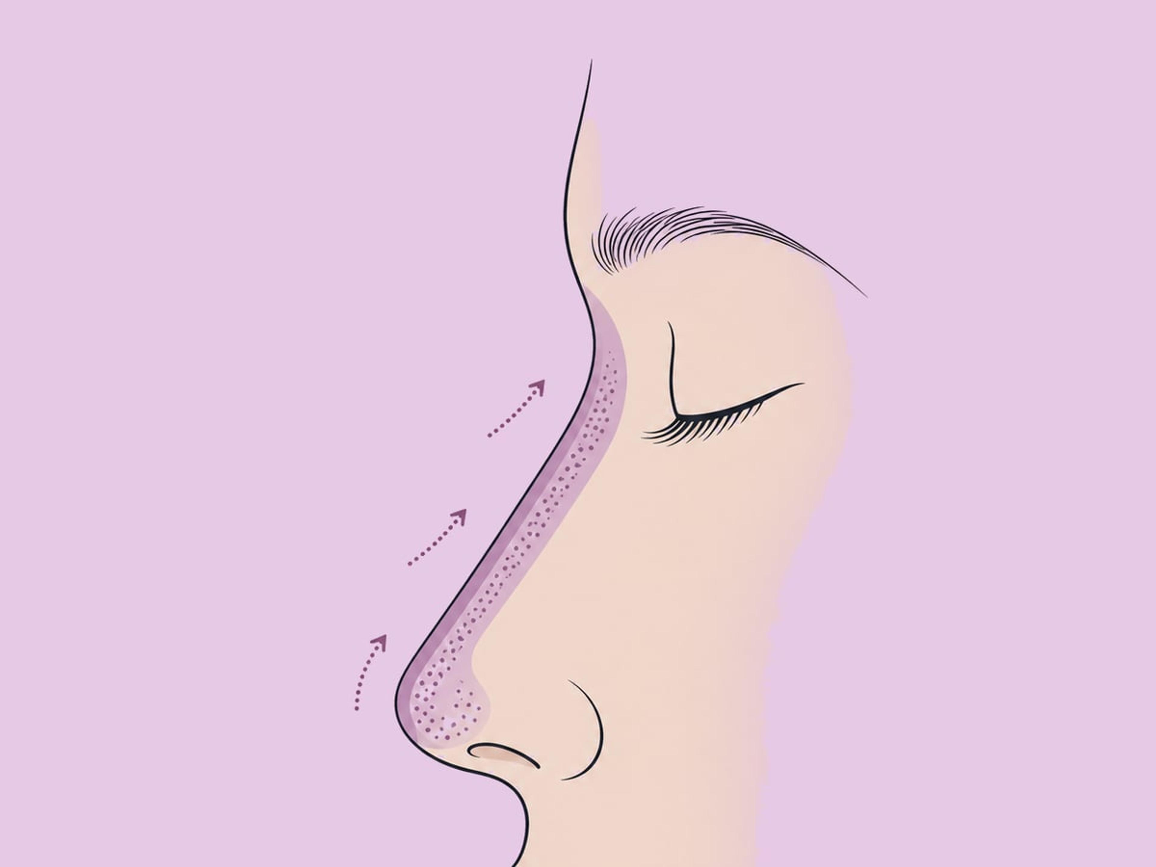 Hyaluronsäure-Filler — illustration