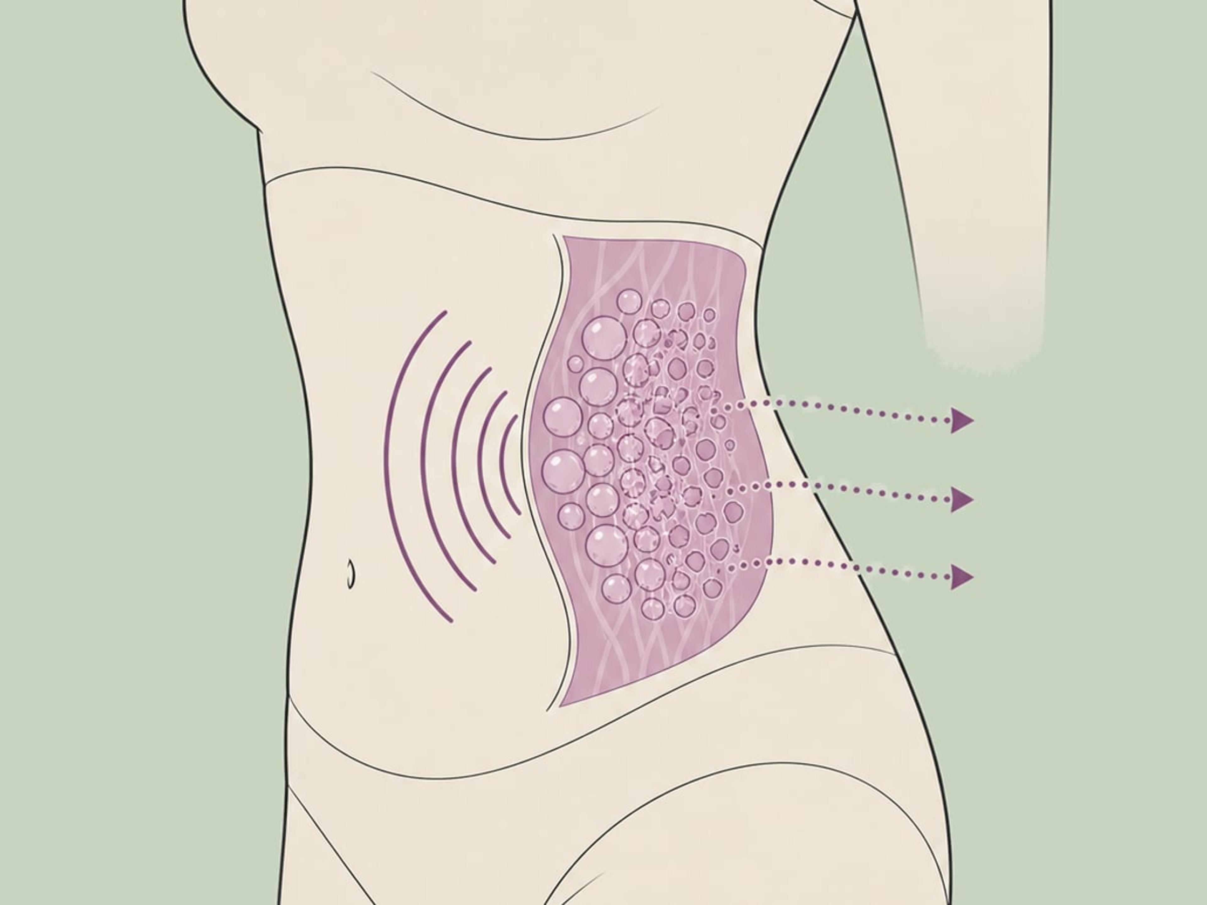 Ultraschallassistierte Fettabsaugung (VASER) — illustration