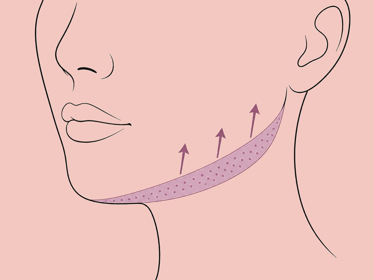 HArmonyCa (hybride HA und Calciumhydroxylapatit) — illustration