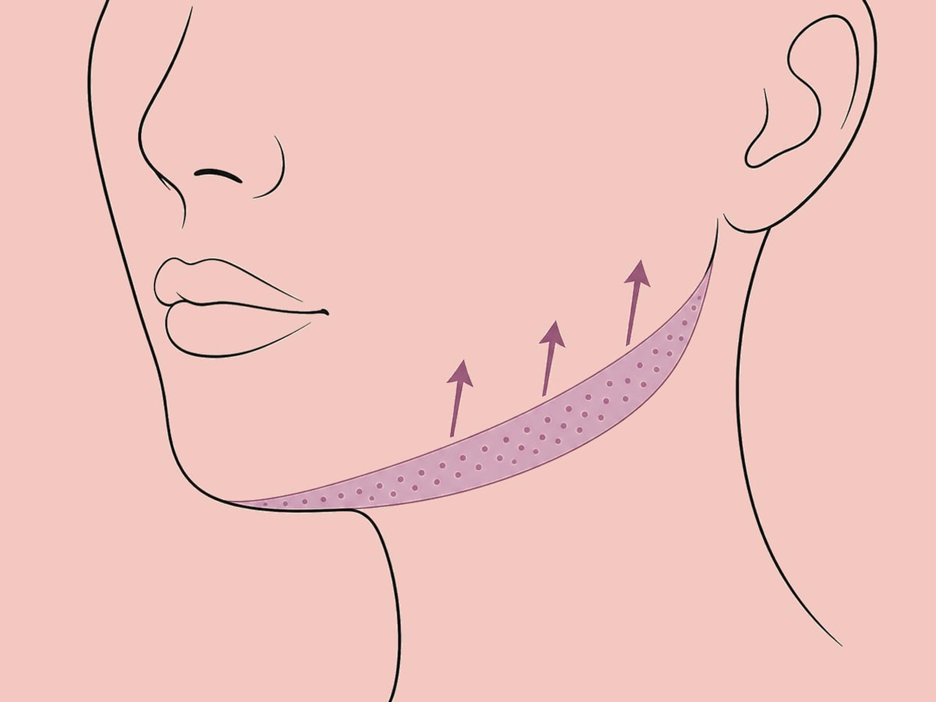 HArmonyCa (hybride HA und Calciumhydroxylapatit) — illustration