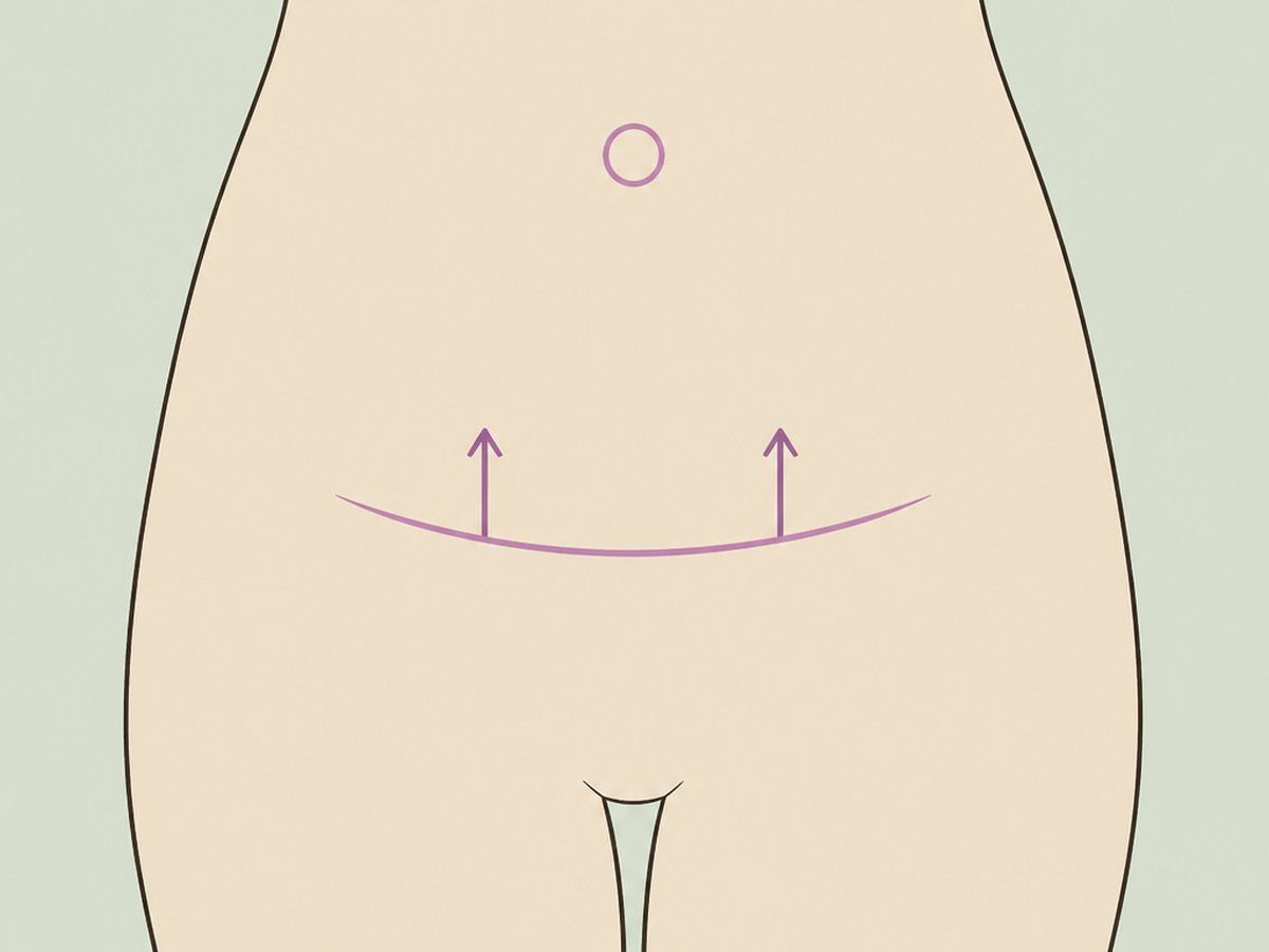 Umbilikoplastik und Schamhügelstraffung — illustration