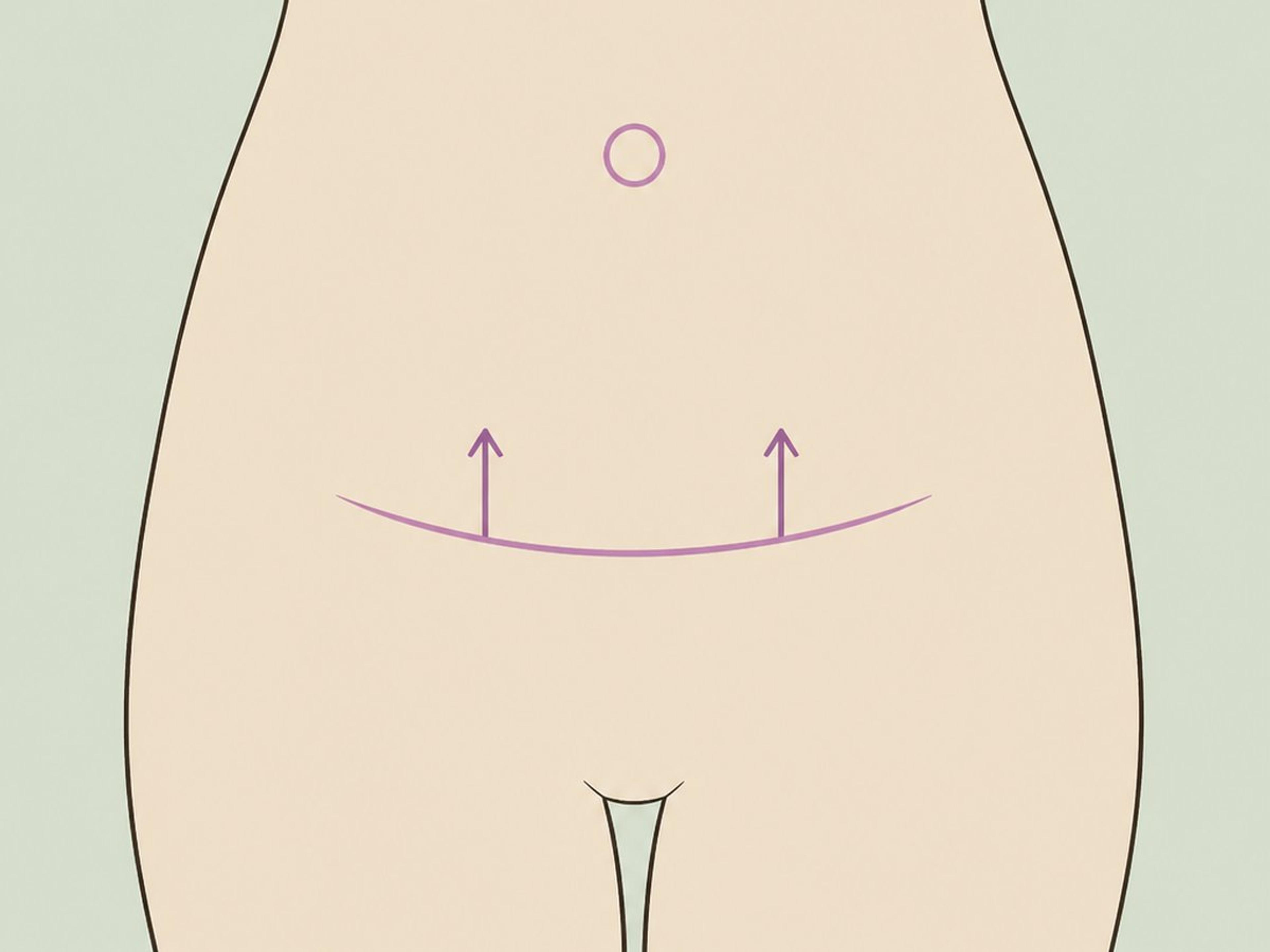 Umbilikoplastik und Schamhügelstraffung — illustration