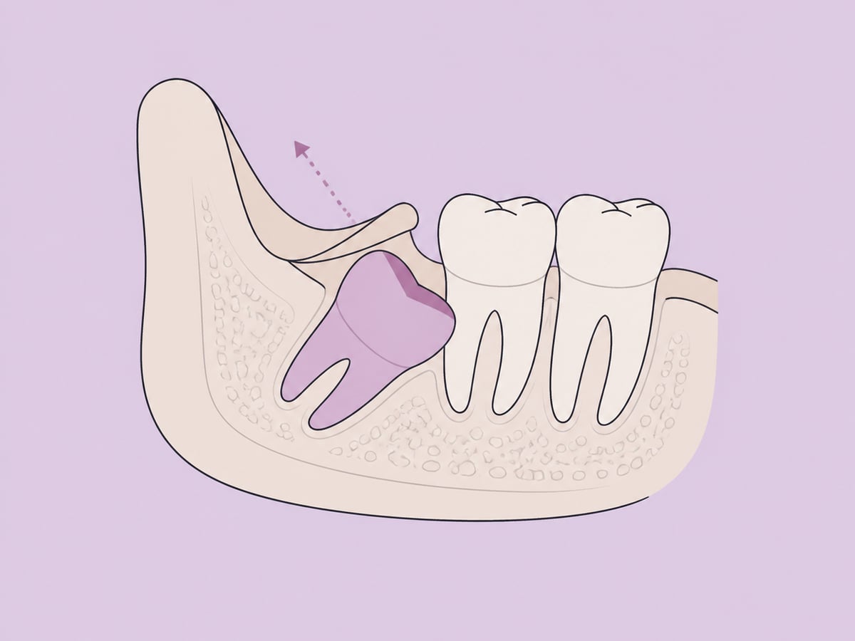 Extraction chirurgicale (ouverte) — illustration