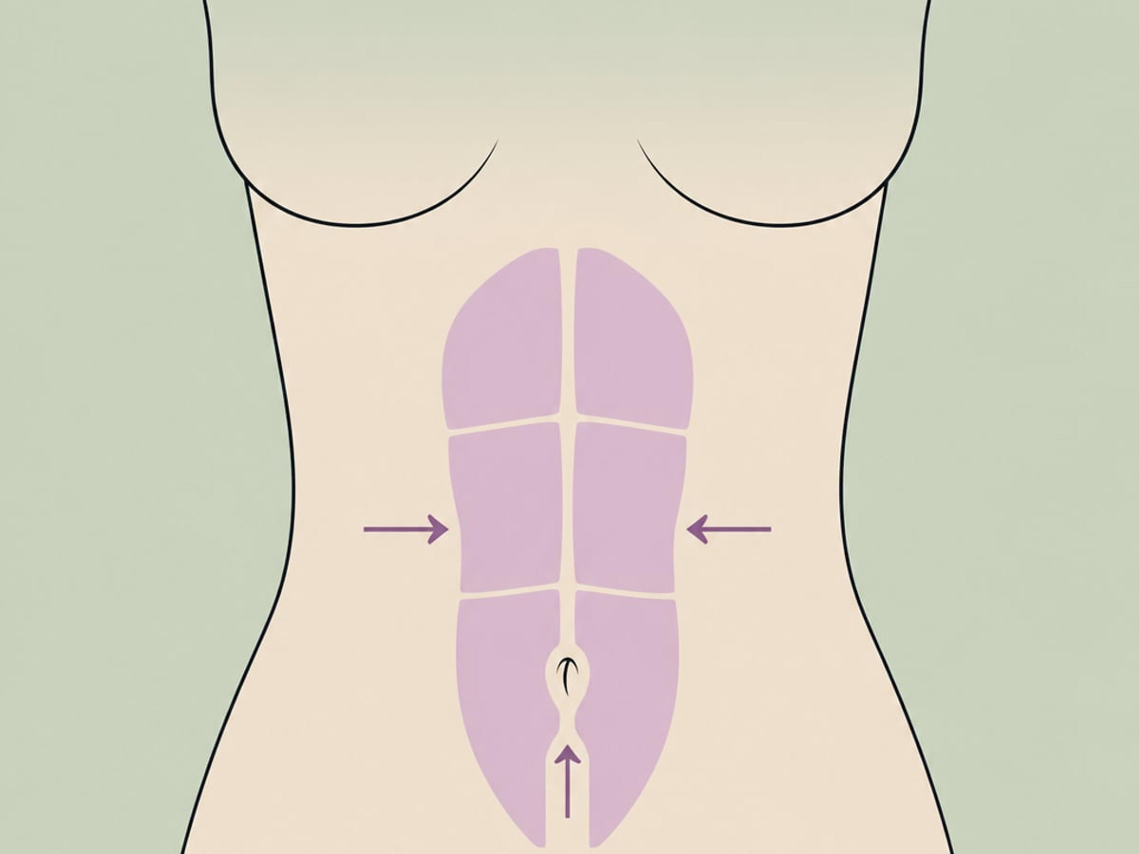 Vollständige Abdominoplastik — illustration
