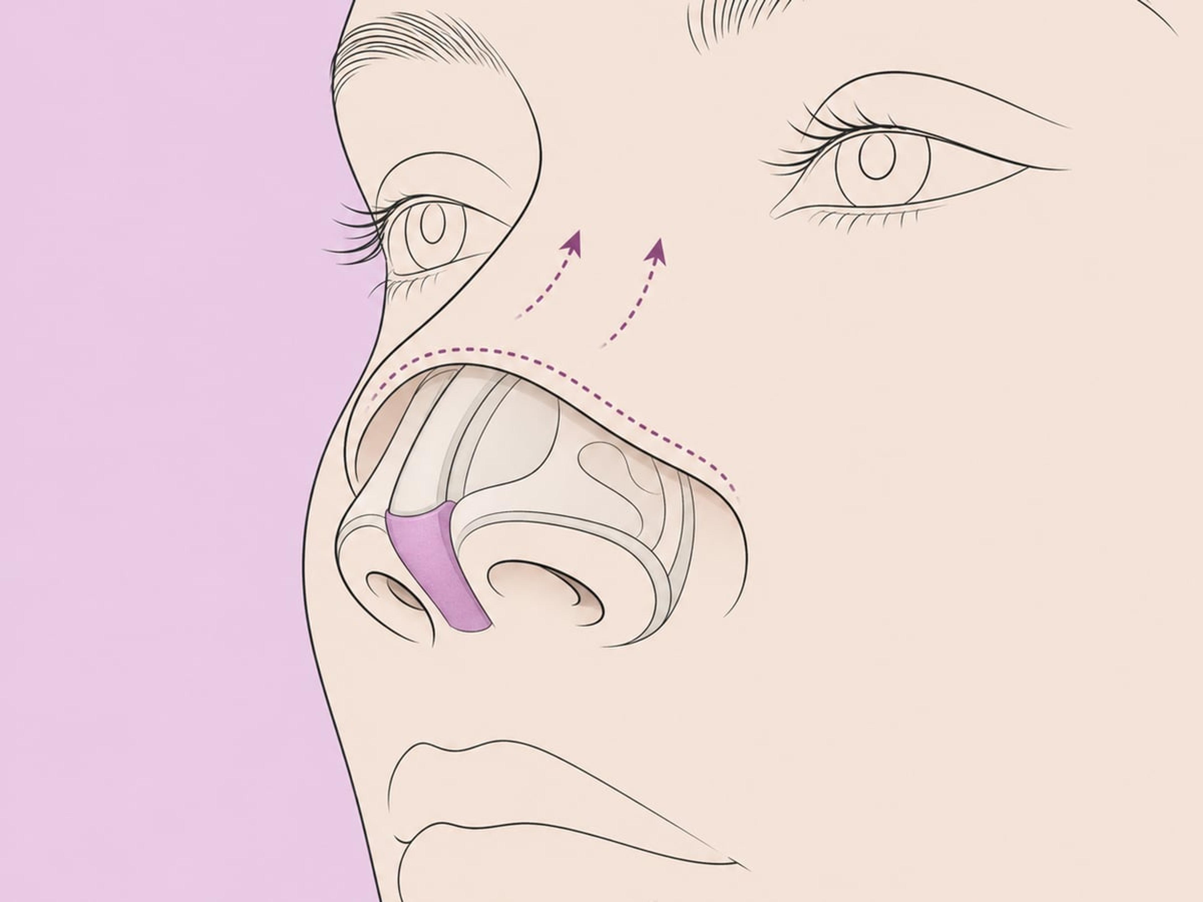 Offene Rhinoplastik — illustration