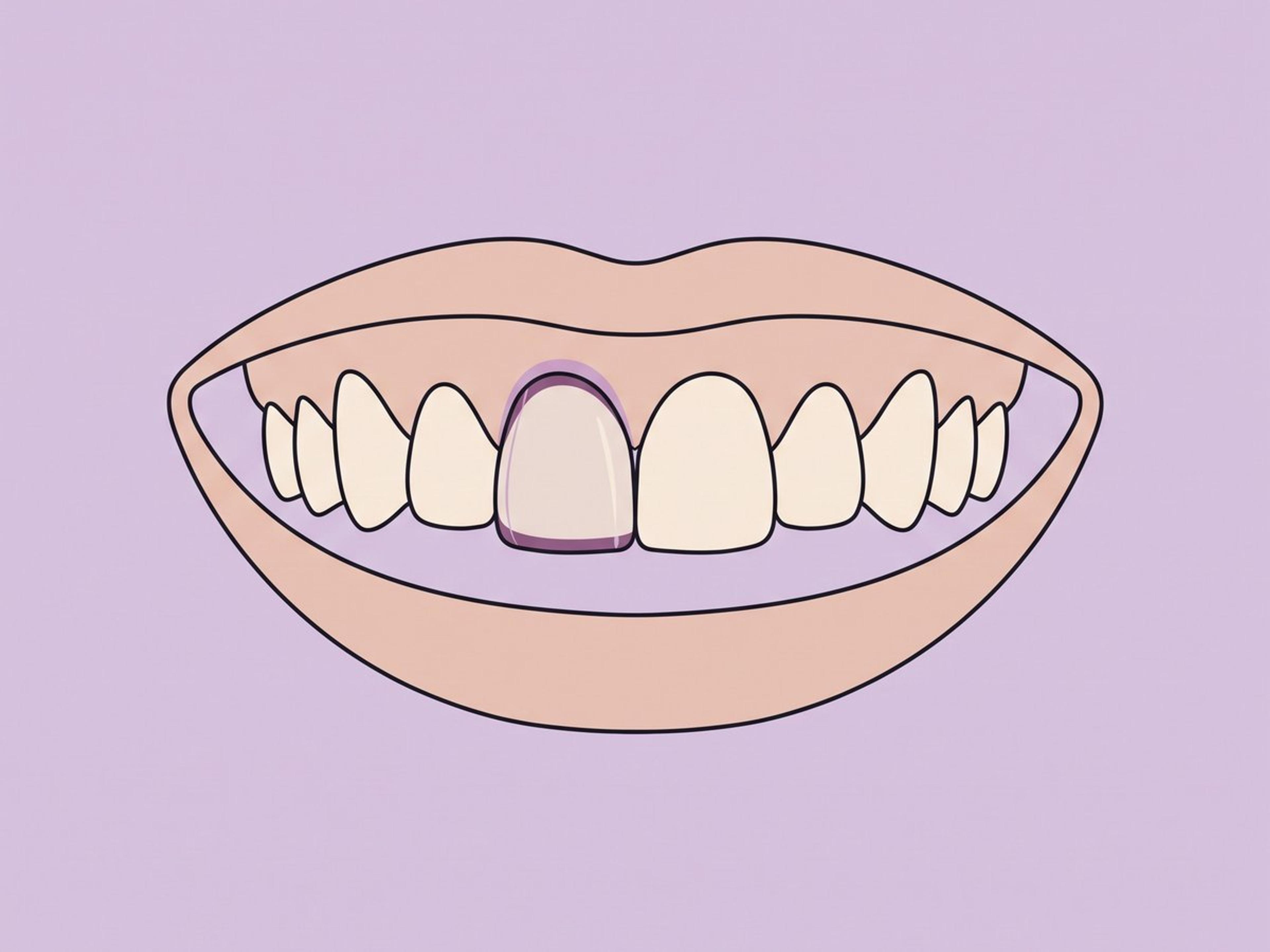 تاج ثاني سيليكات الليثيوم أحادي الكتلة (سيراميك زجاجي) — illustration