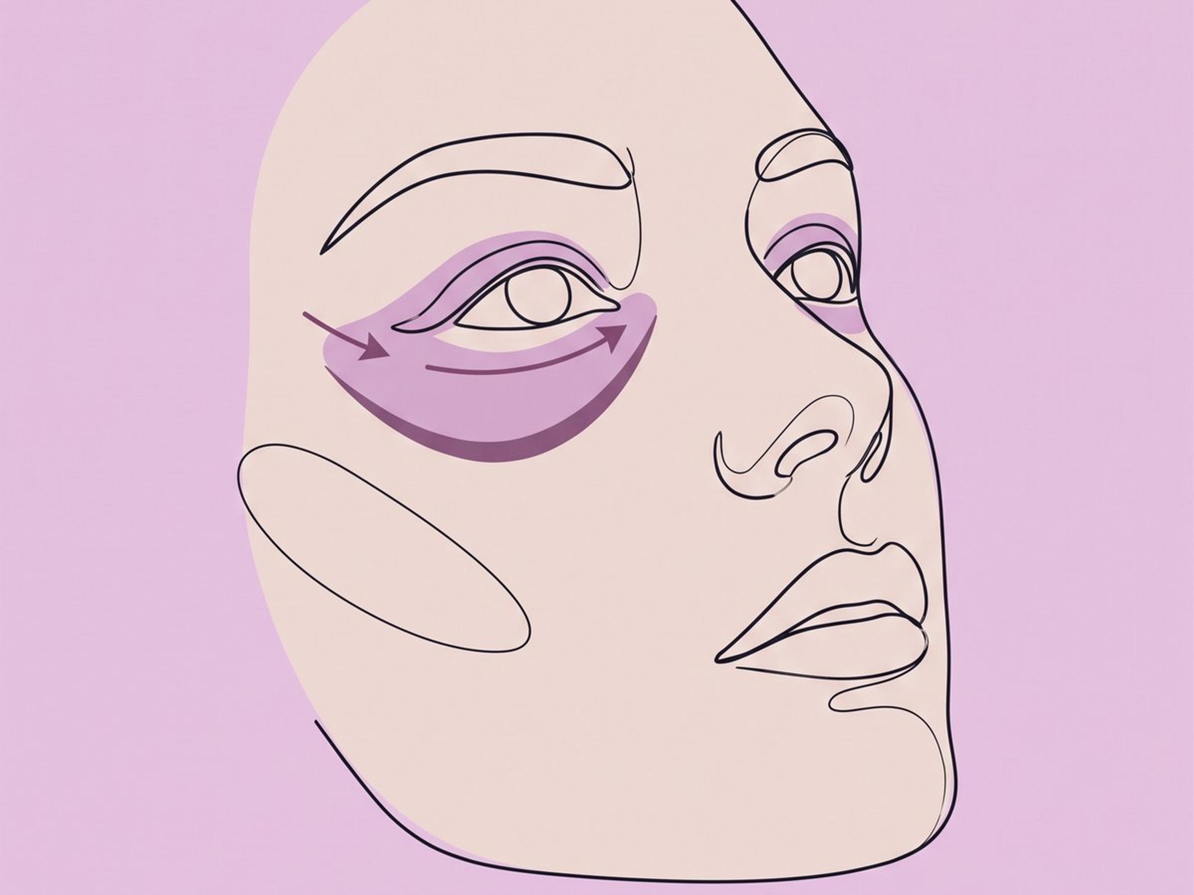 Platzierung über das Unterlid (subziliär oder transkonjunktival) — illustration