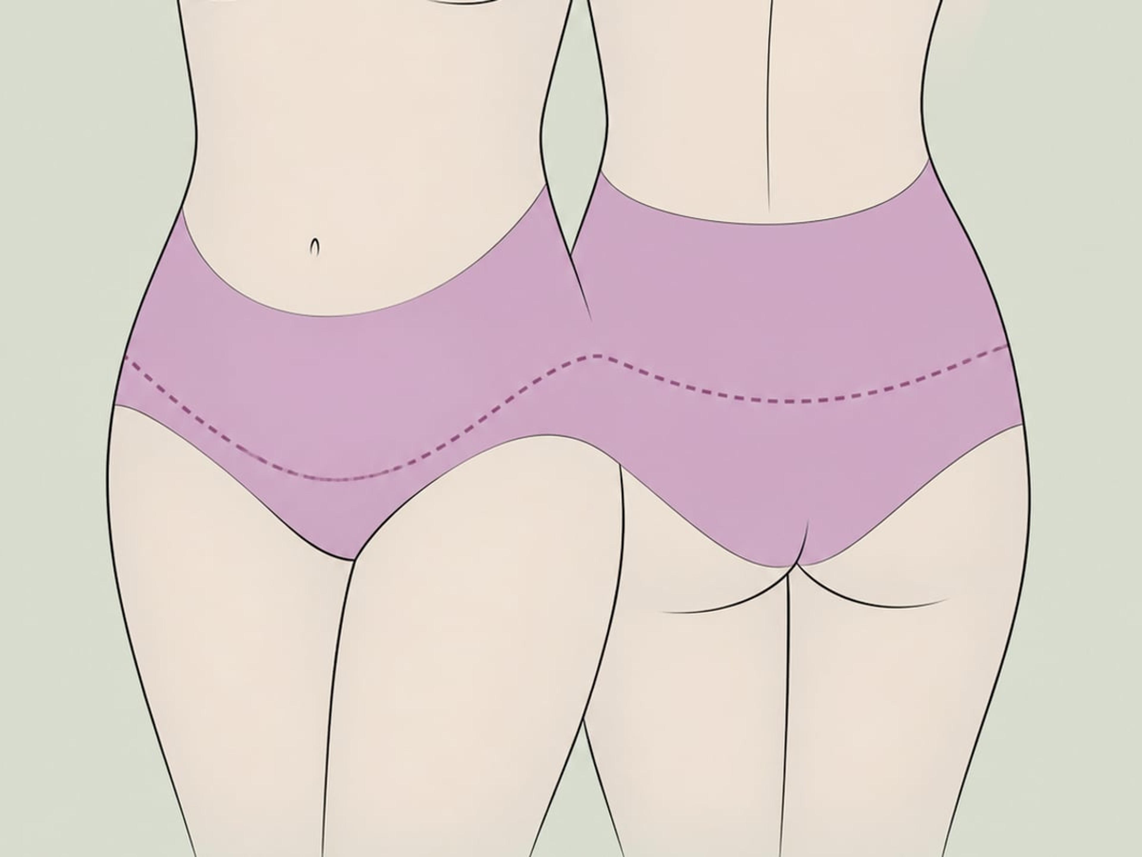 Erweiterte Bauchdeckenstraffung — illustration
