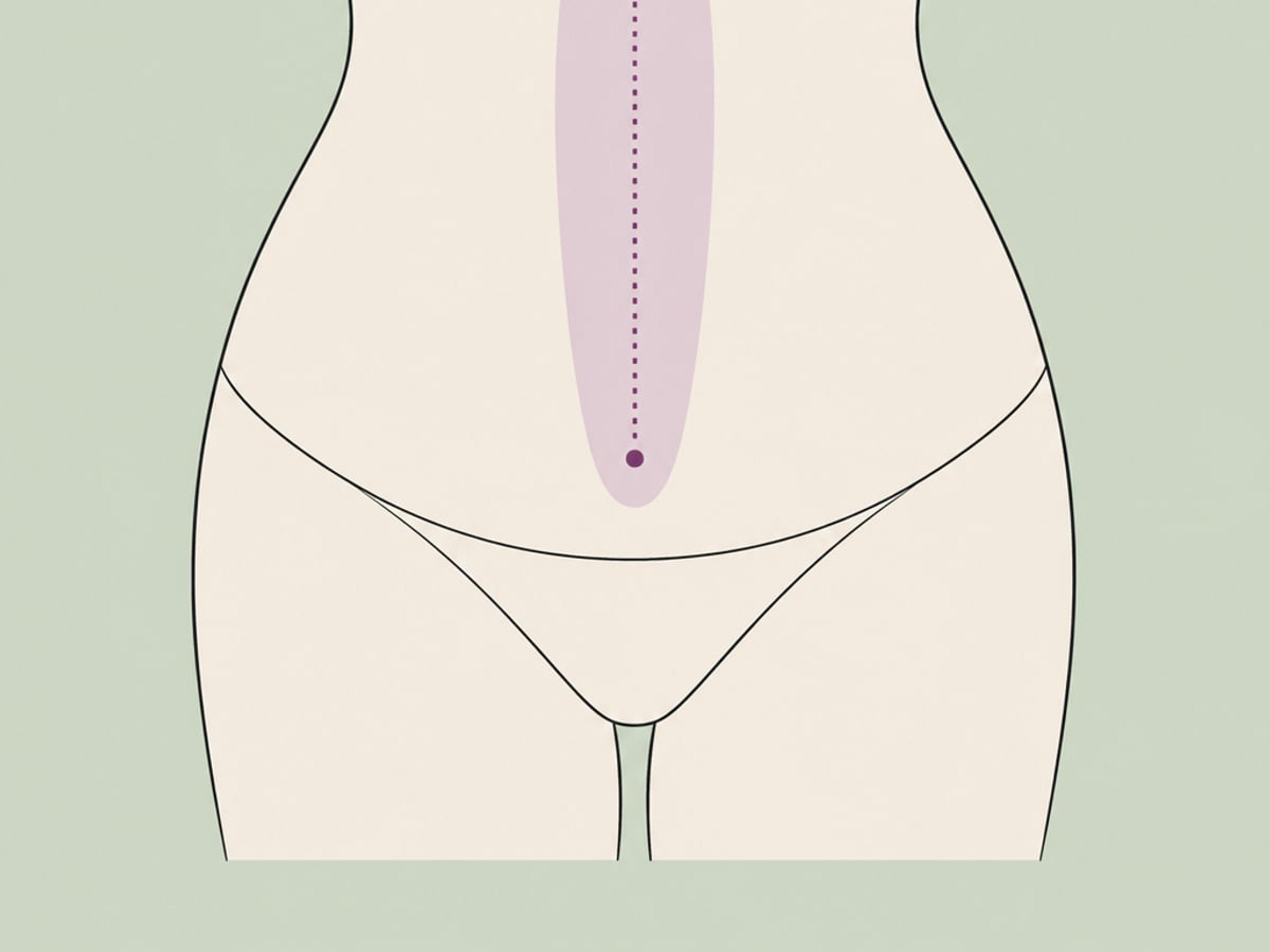 Bauchdeckenstraffung + Bruststraffung — illustration