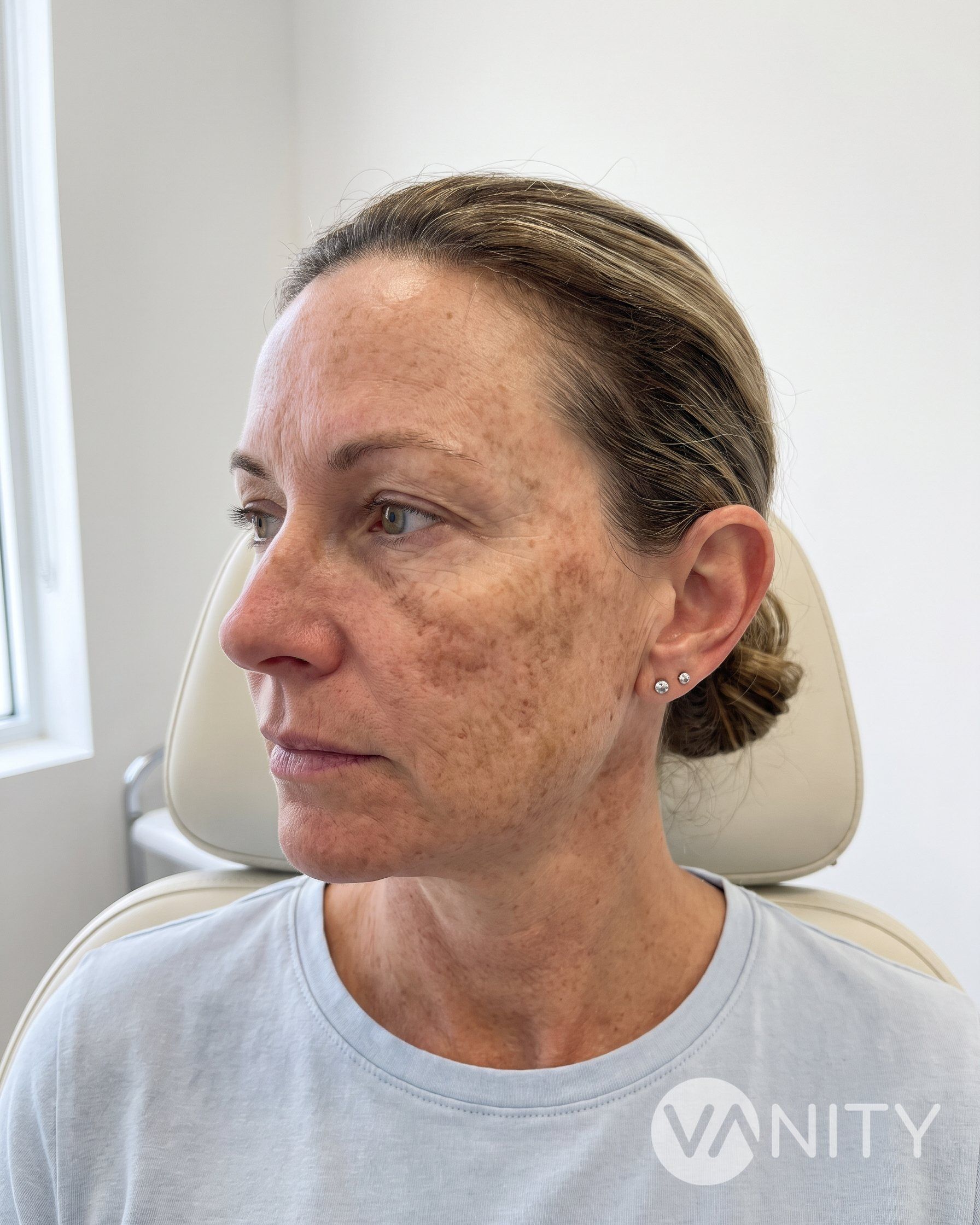 Before Fractional laser — illustrative, not a real patient