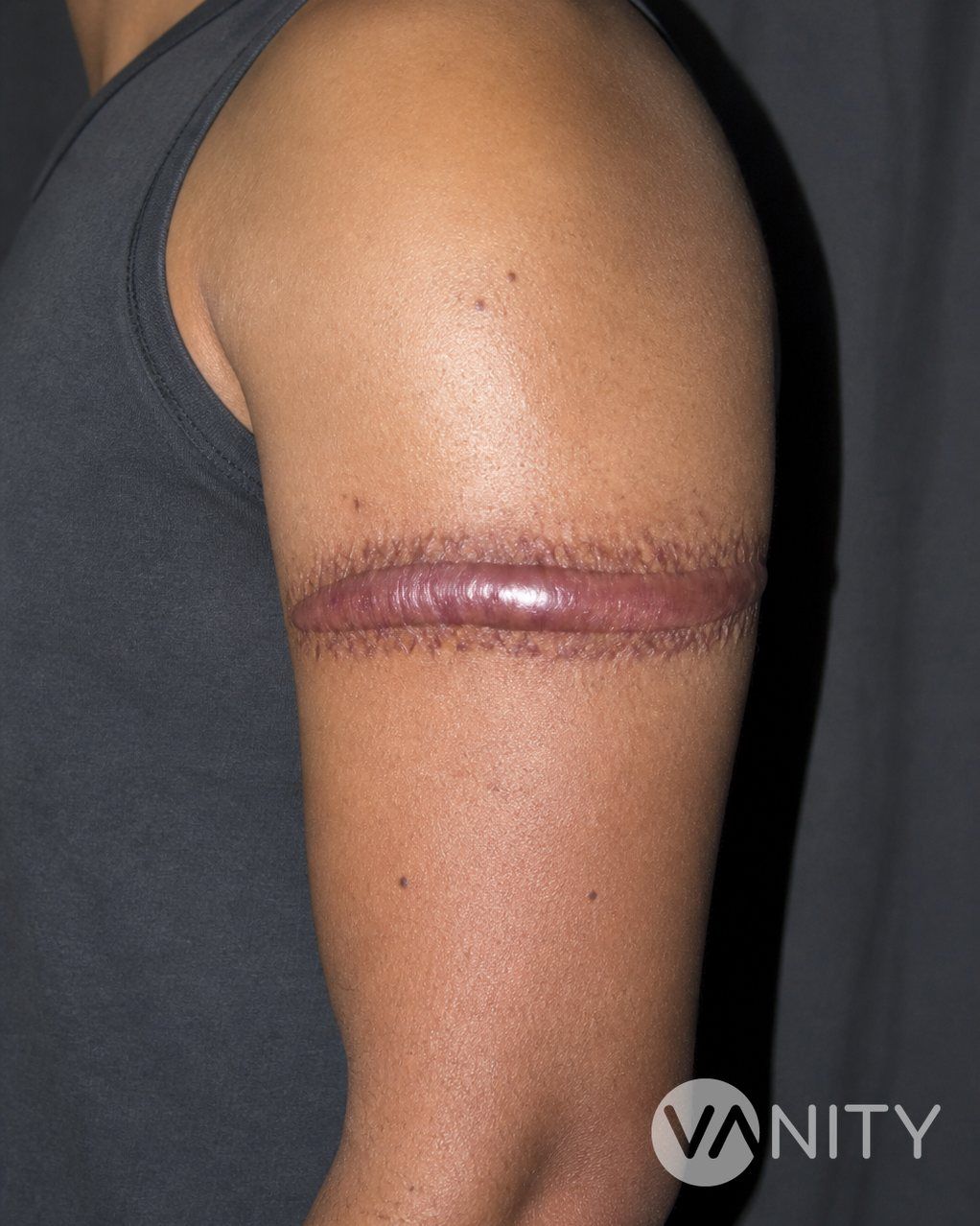 Before Scar revision — illustrative, not a real patient