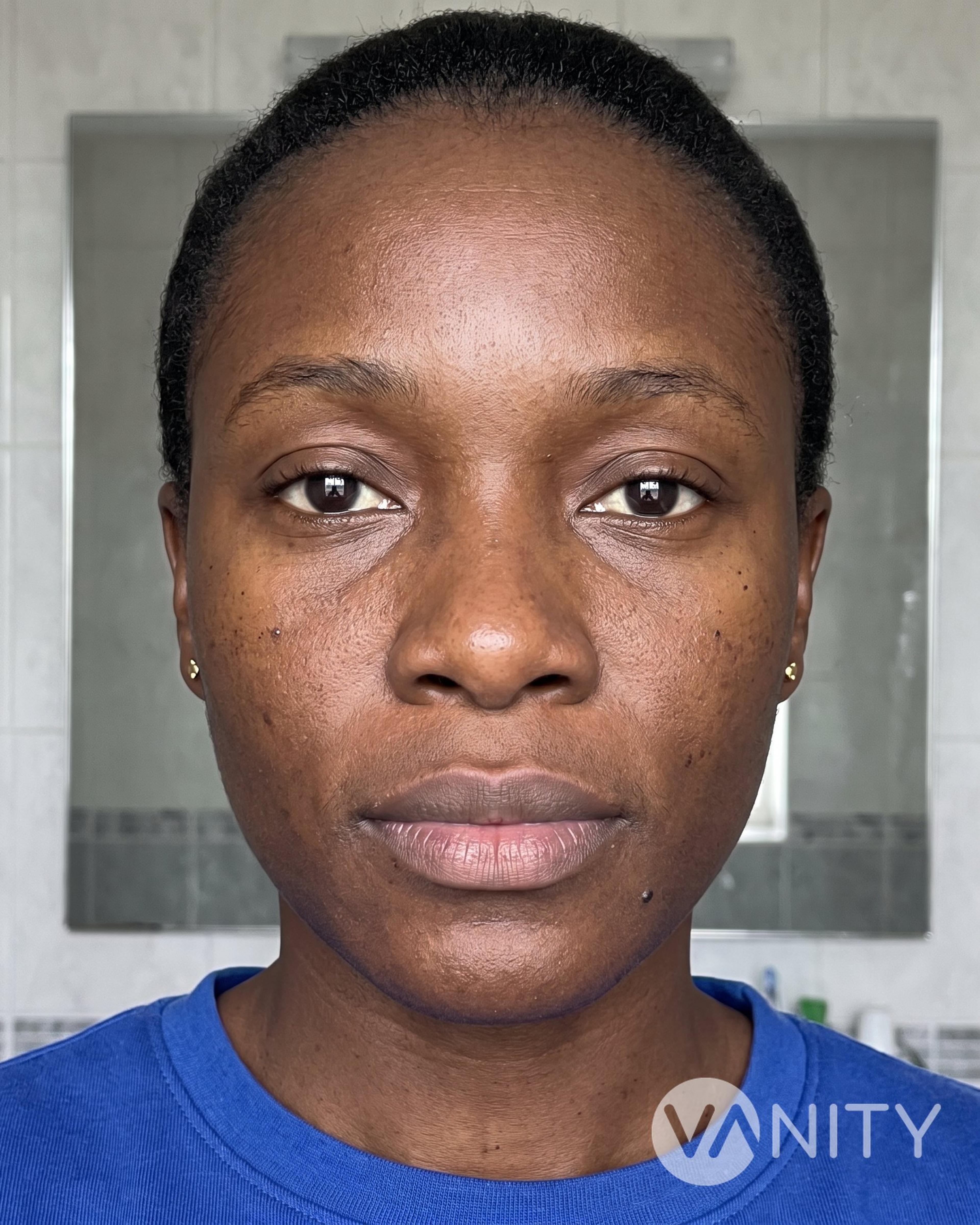Before Lip fillers — illustrative, not a real patient