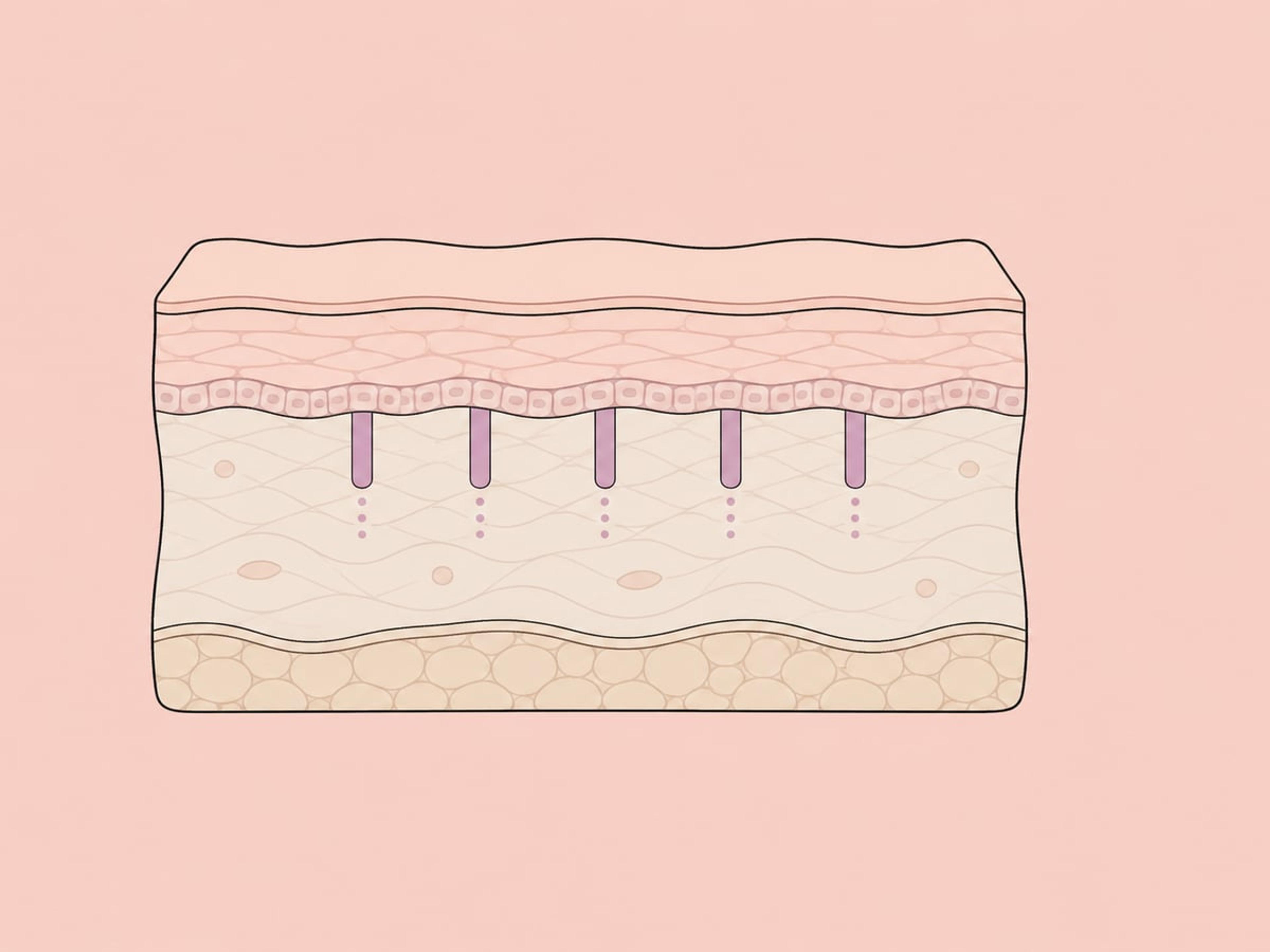 Fraktionierter ablativer Erbium:YAG-Laser (2.940 nm) — illustration
