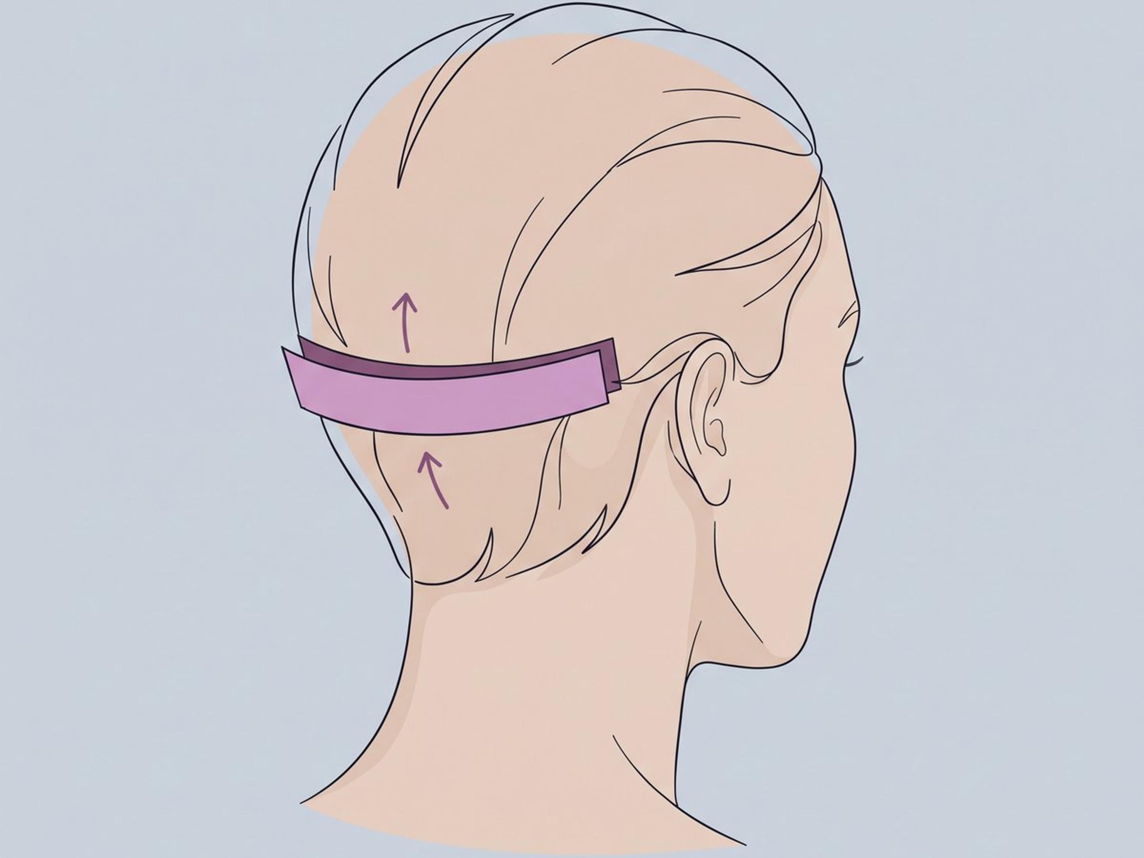 Follicular Unit Transplantation (FUT / Streifenentnahme) — illustration