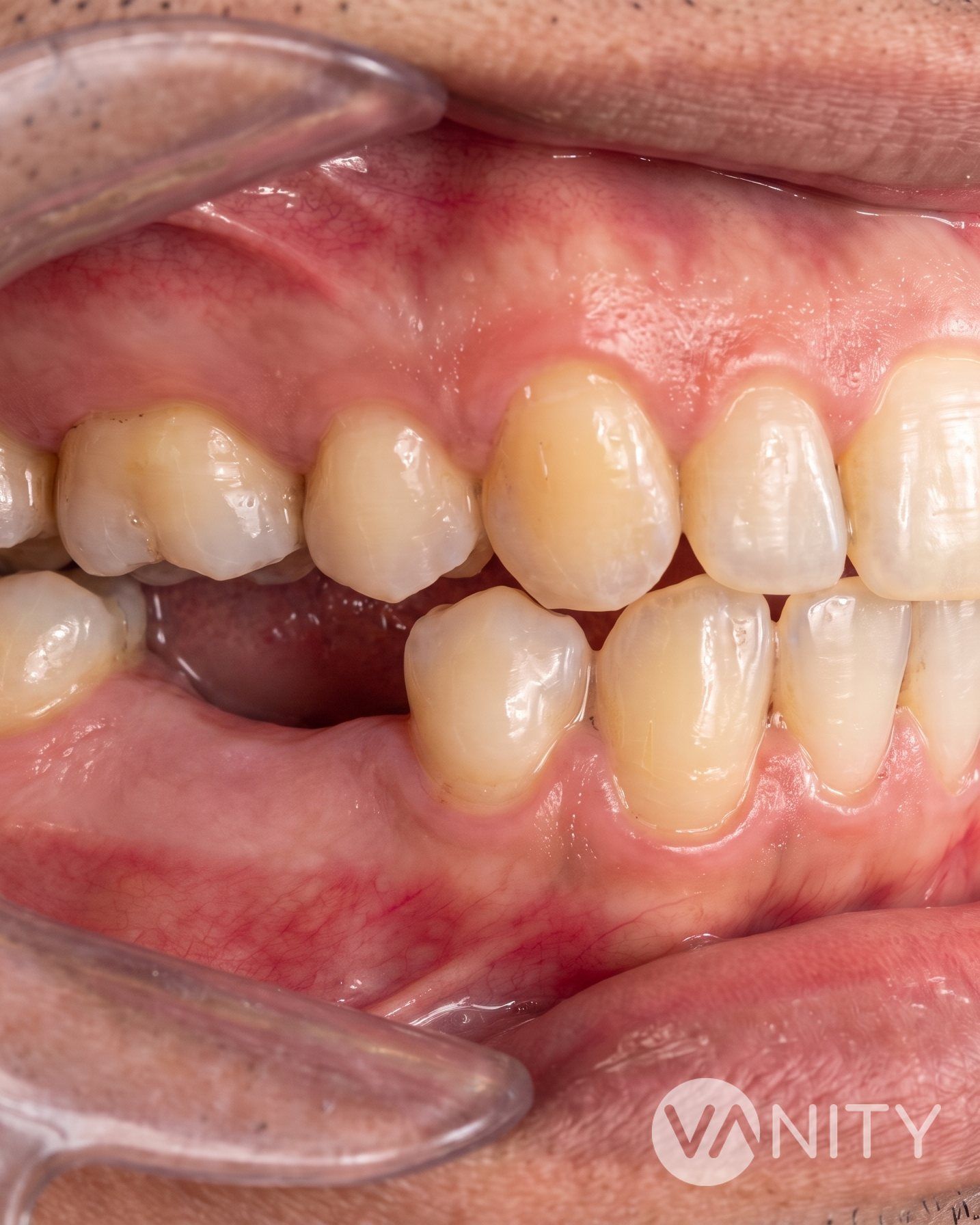 After Tooth extraction — illustrative, not a real patient