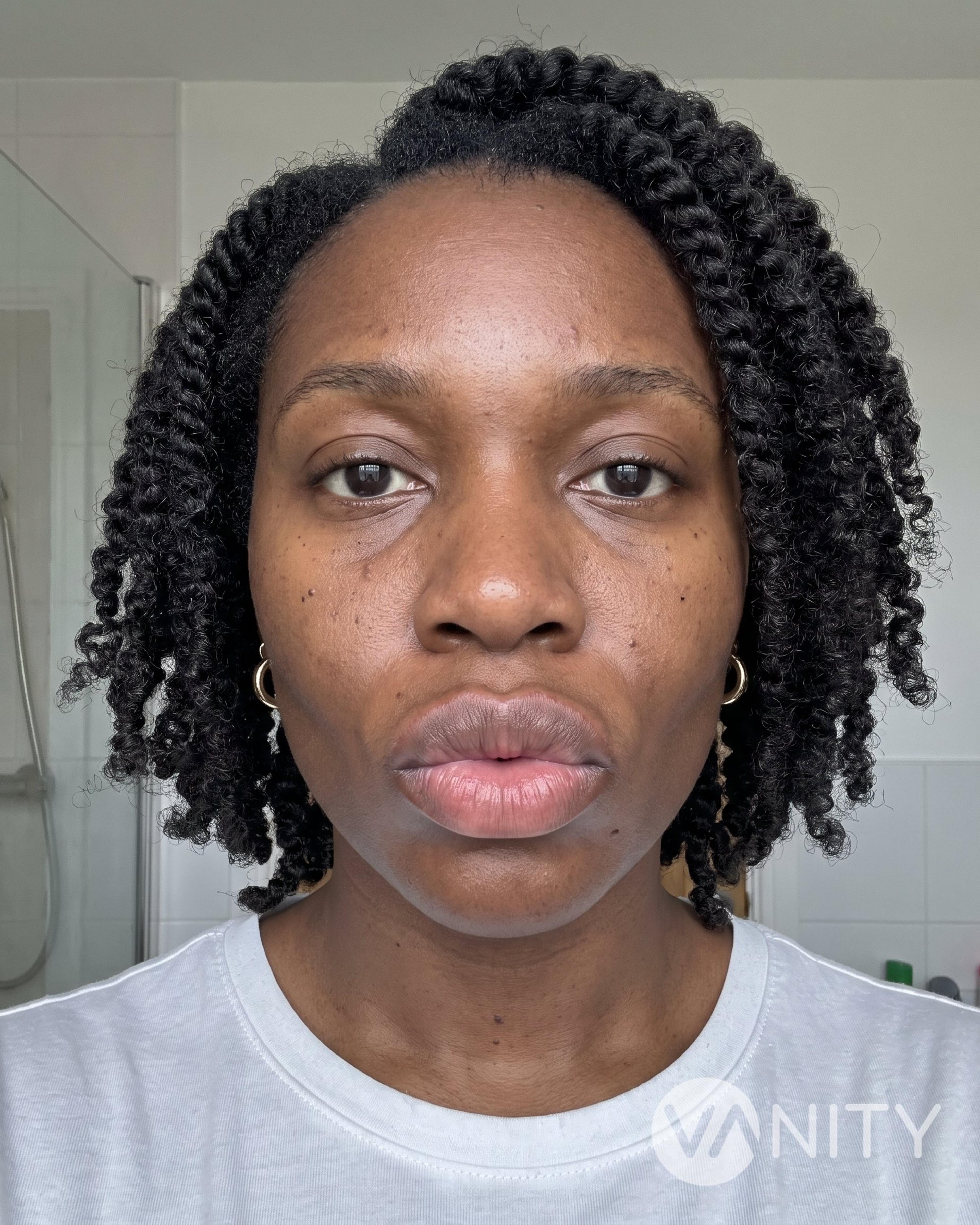 Before Filler dissolving — illustrative, not a real patient