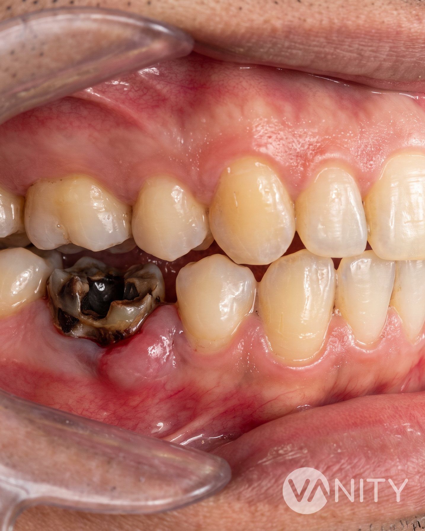 Before Tooth extraction — illustrative, not a real patient