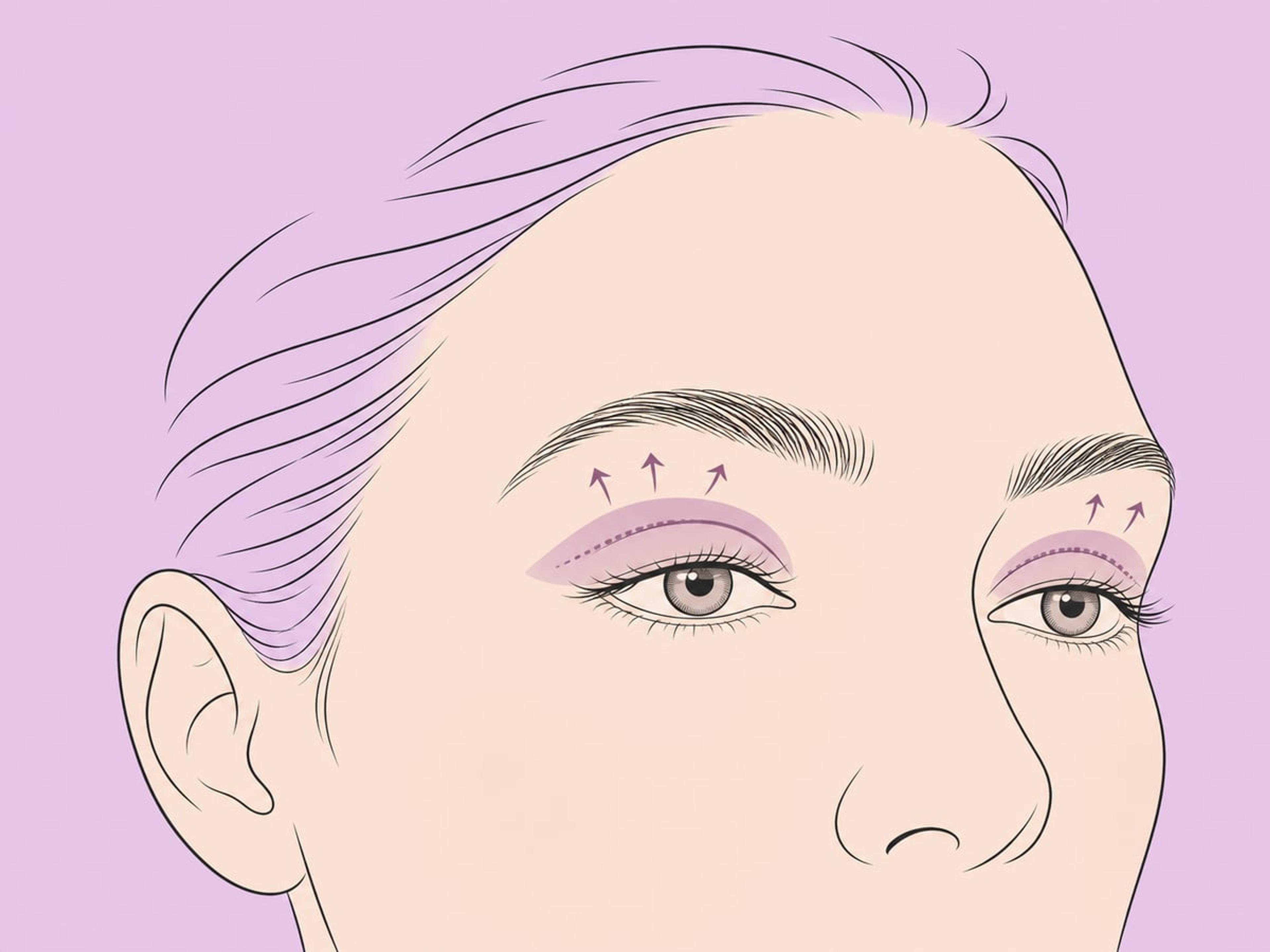Oberlid-Blepharoplastik — illustration