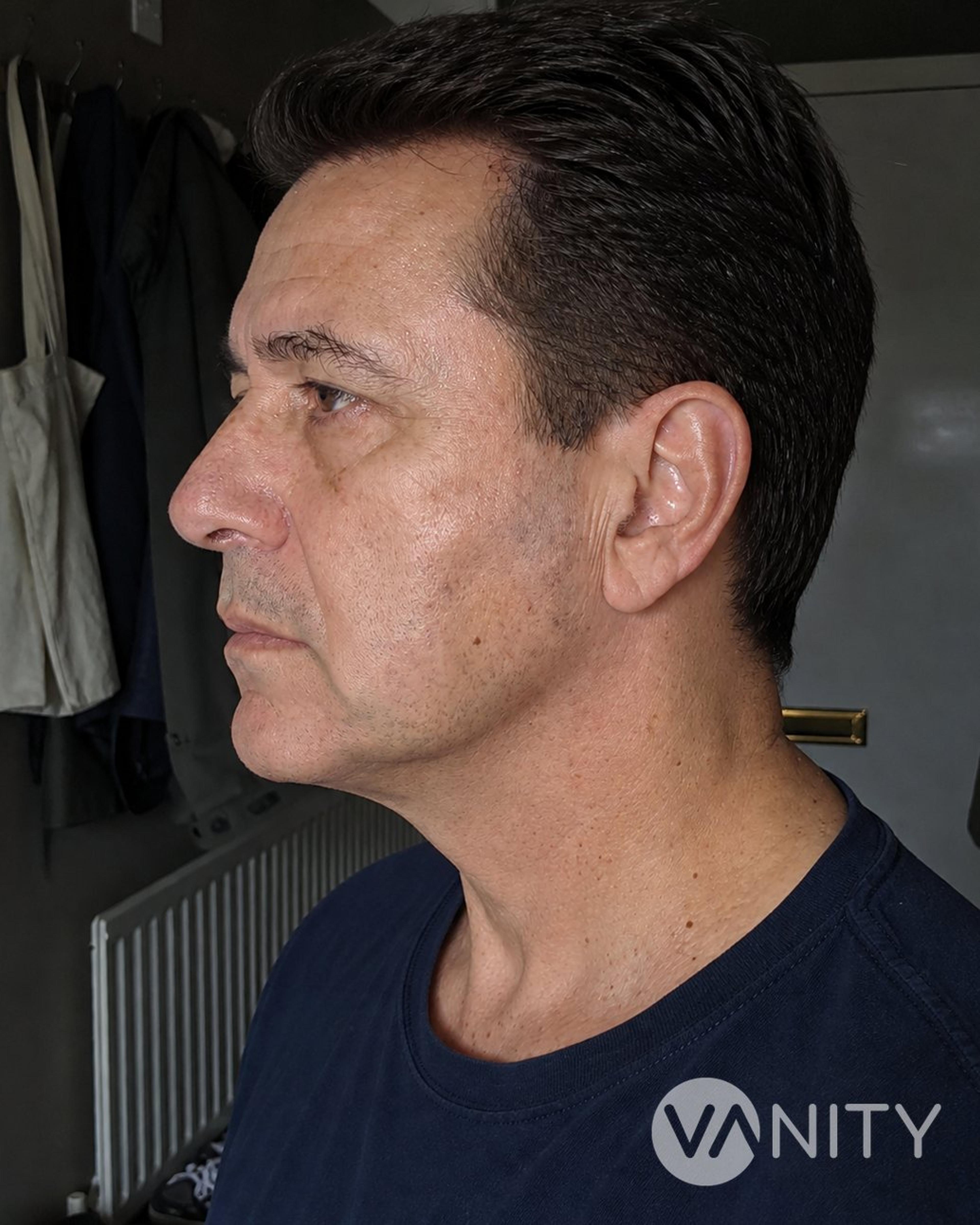 After Neck lift — illustrative, not a real patient