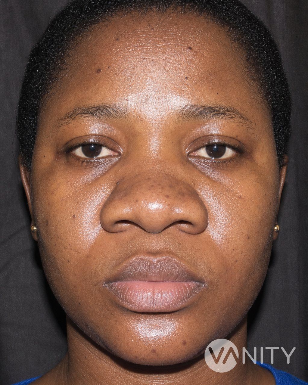 Before Ethnic rhinoplasty — illustrative, not a real patient