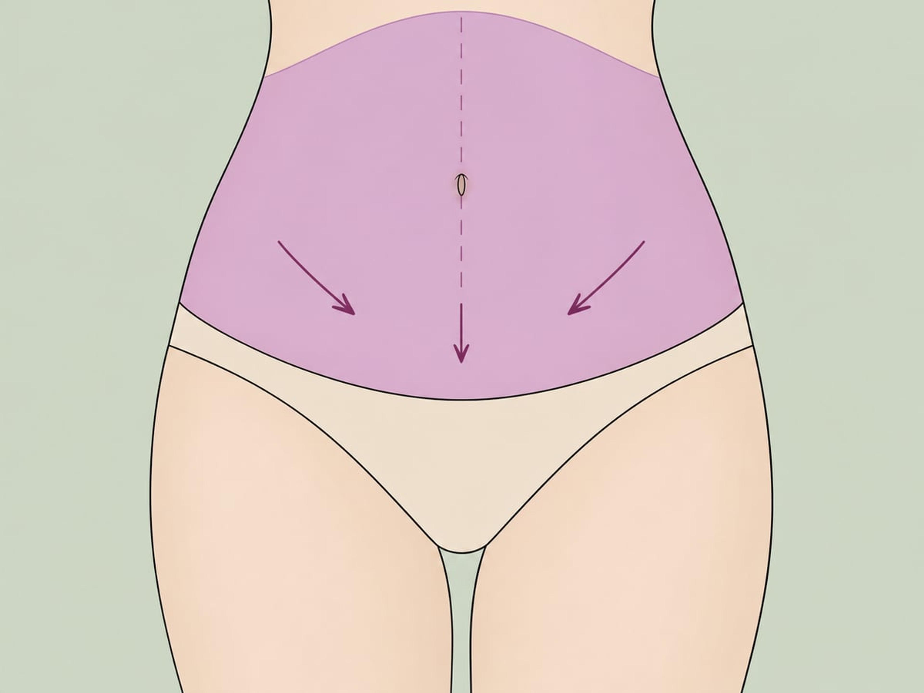 Fleur-de-Lis-Bauchdeckenstraffung (FDL) — illustration