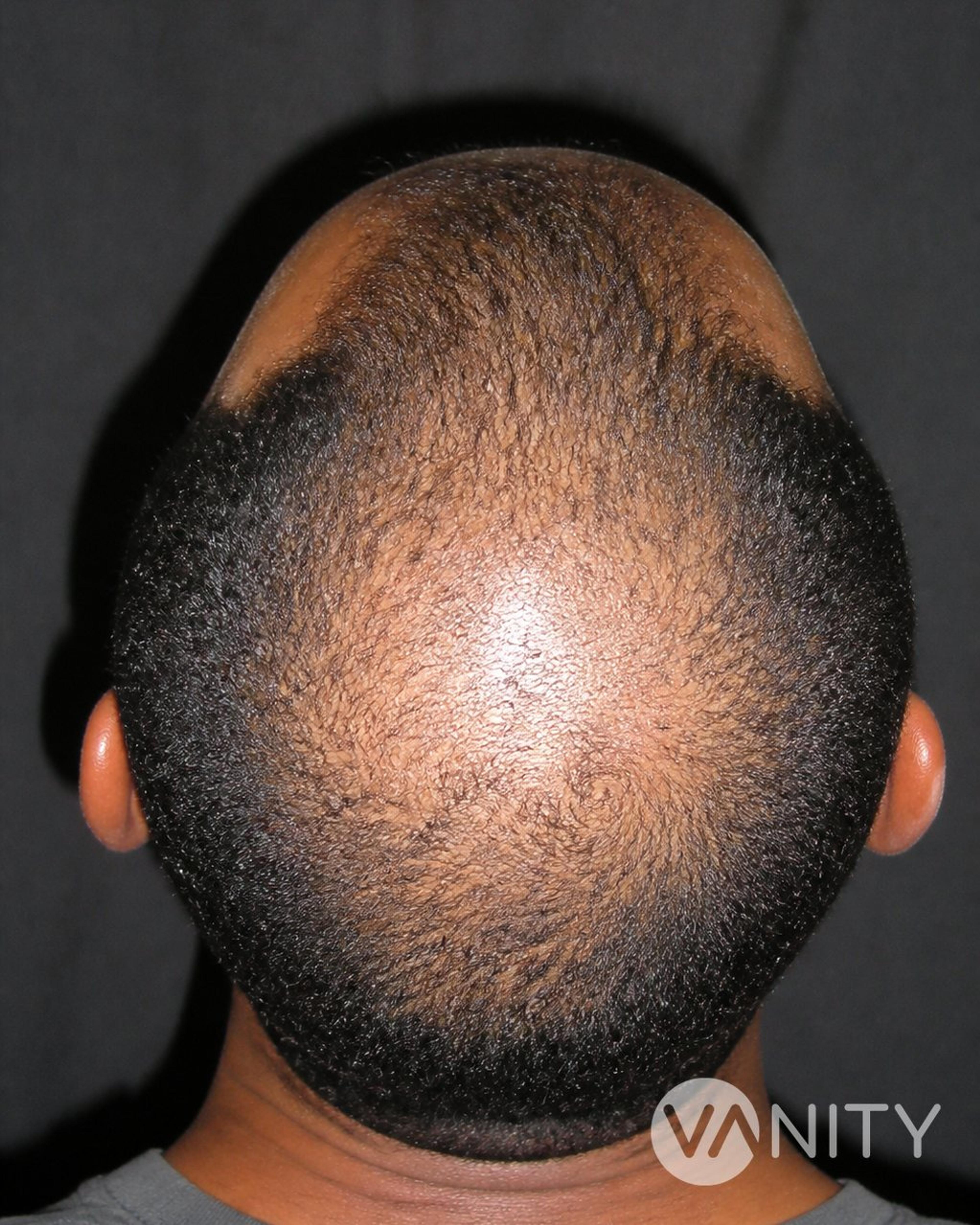 Before Hair stem cell treatment — illustrative, not a real patient