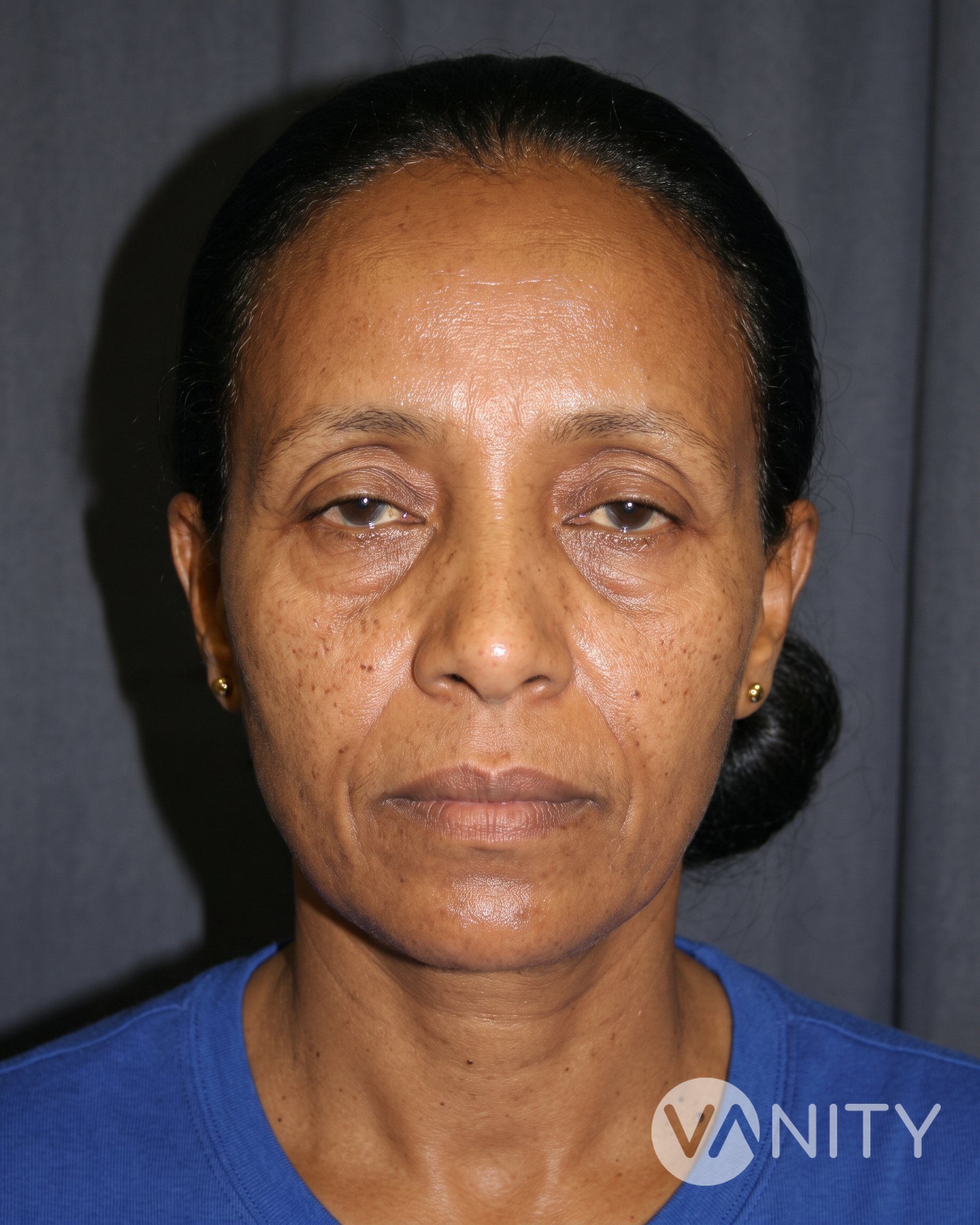 Before Eyelid surgery — illustrative, not a real patient