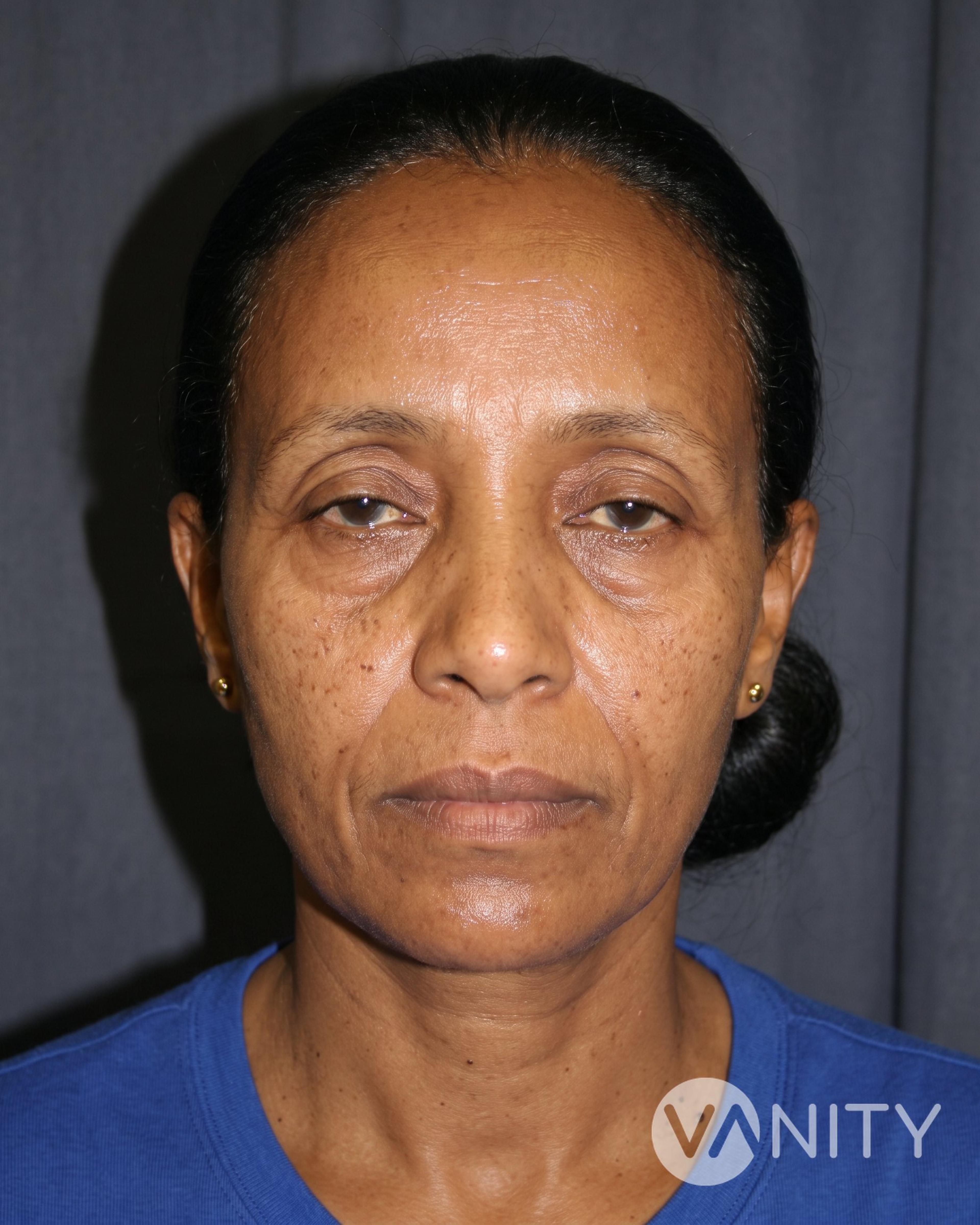 Before Eyelid surgery — illustrative, not a real patient