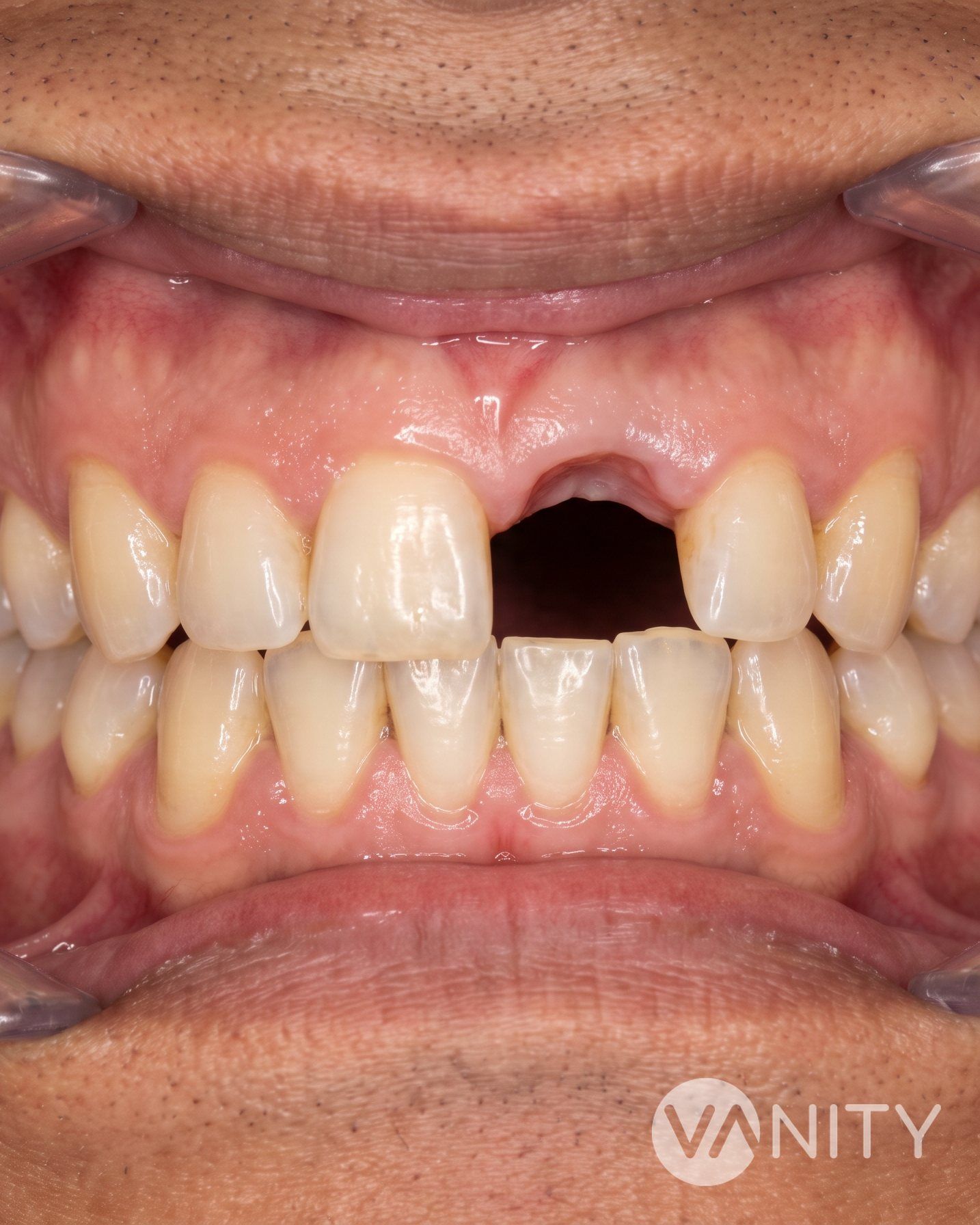 Before Dental implants — illustrative, not a real patient