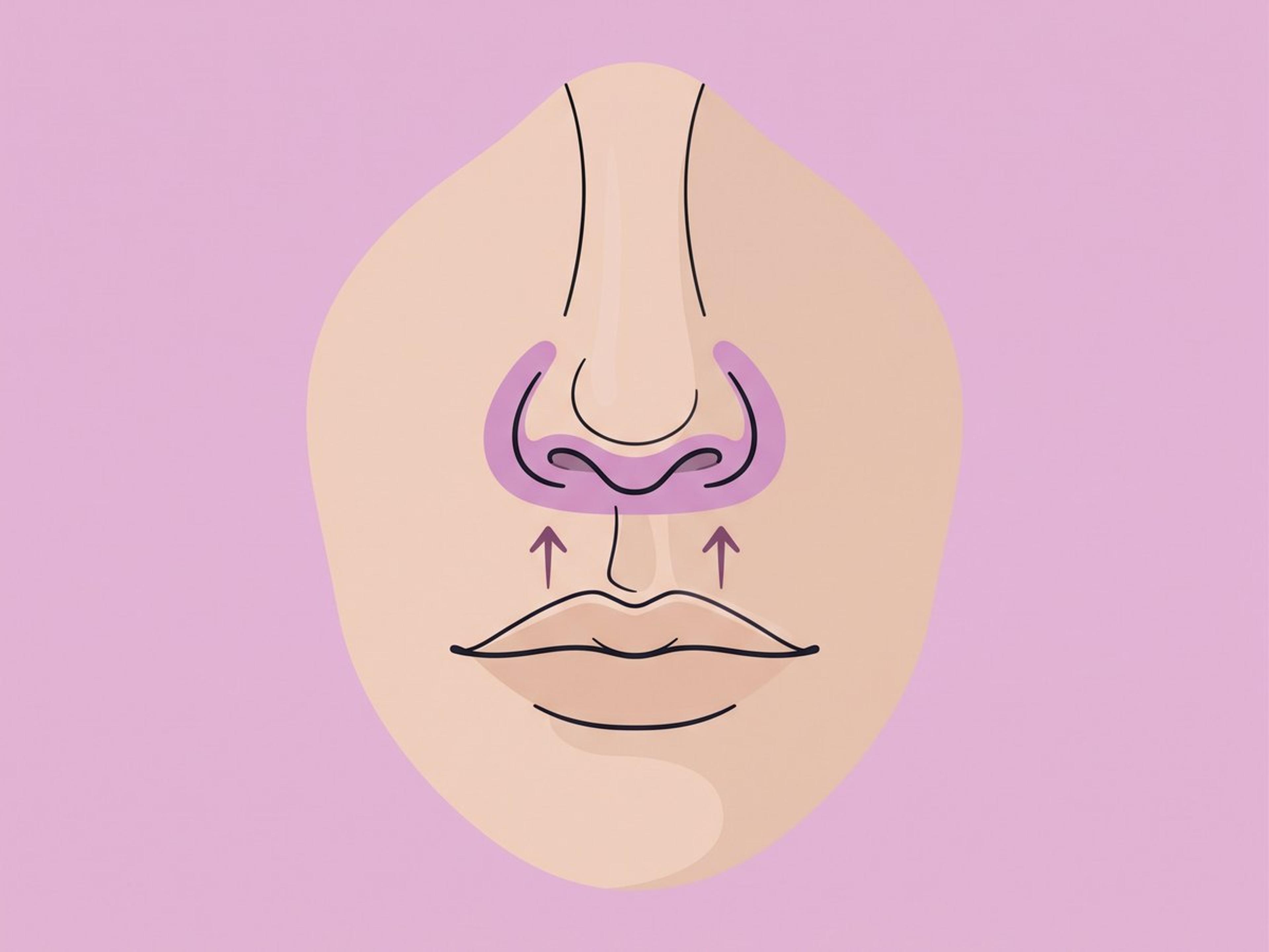 Subnasales (Bullhorn-)Lippenlifting — illustration