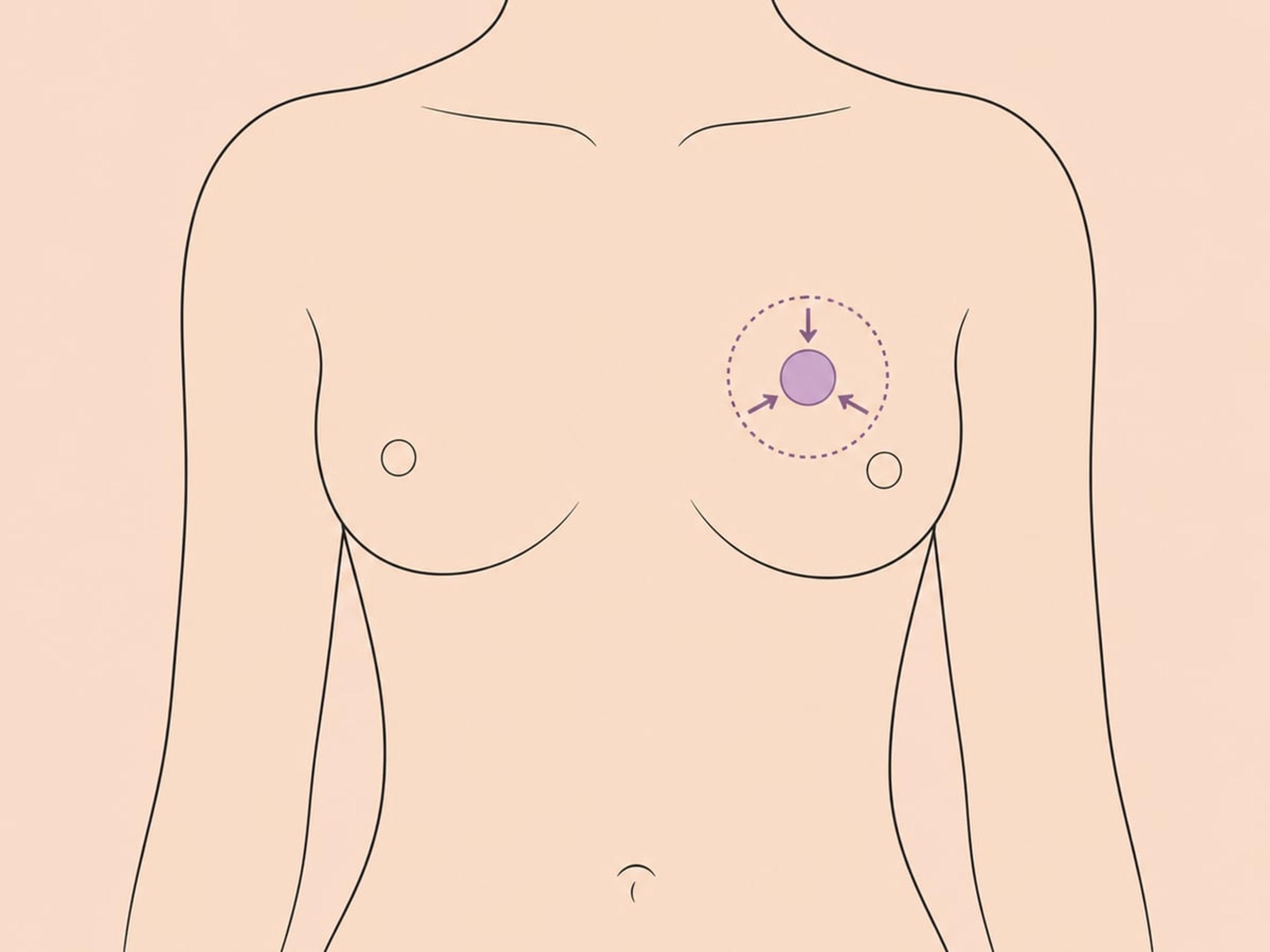 Donut- (periareoläre) Straffung — illustration