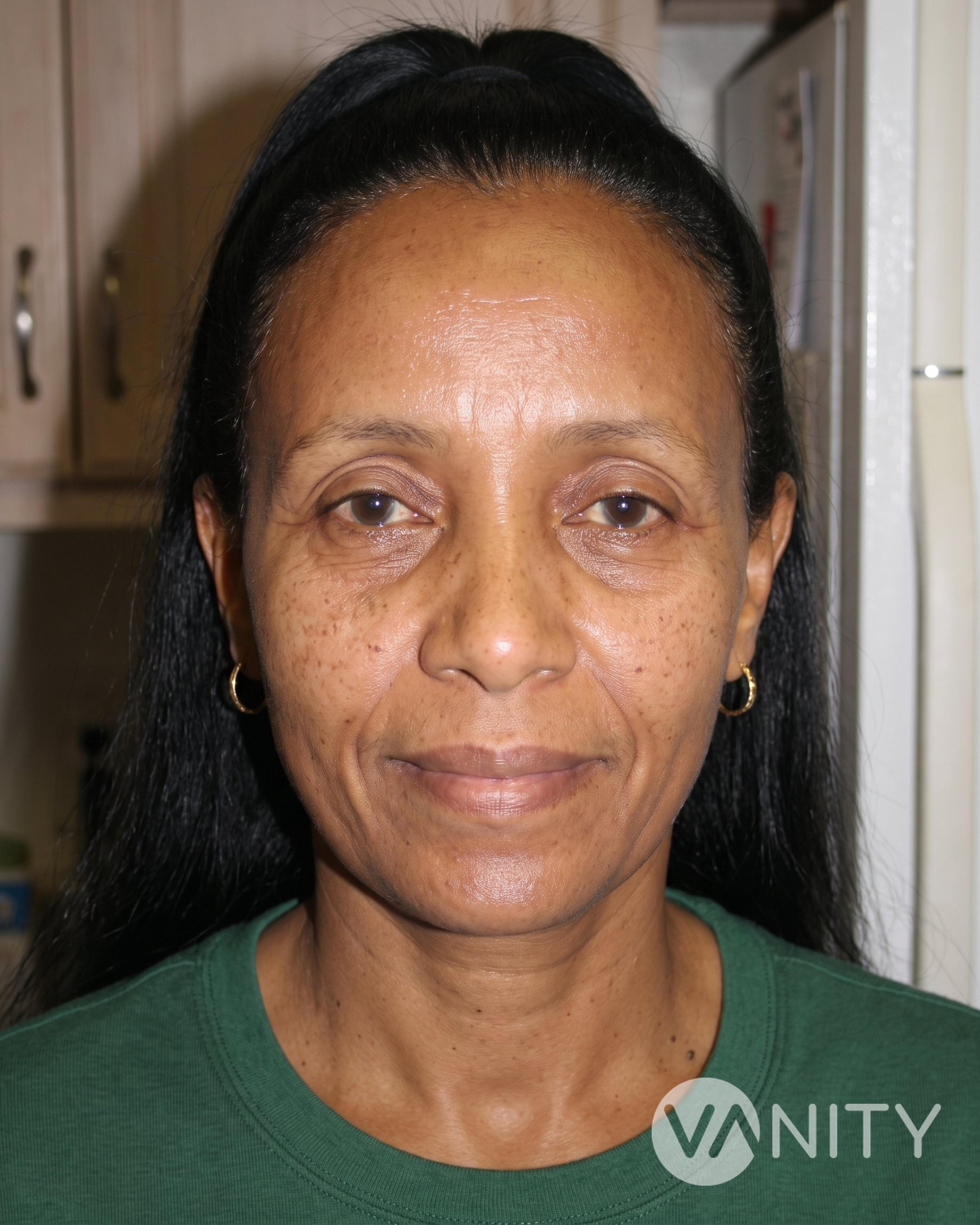 After Eyelid surgery — illustrative, not a real patient