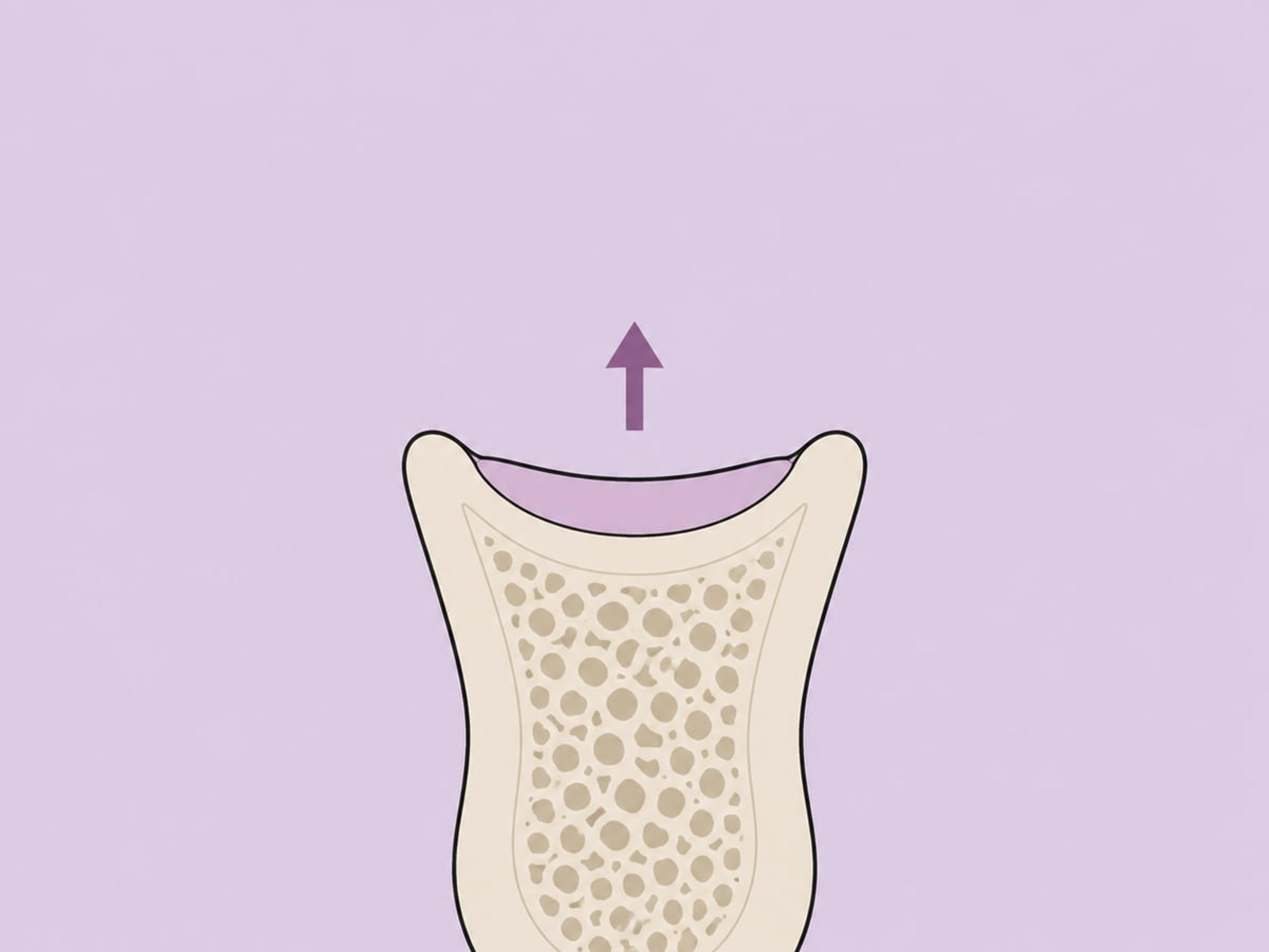 تعزيز العظم قبل الوضع أو بالتزامن معه — illustration
