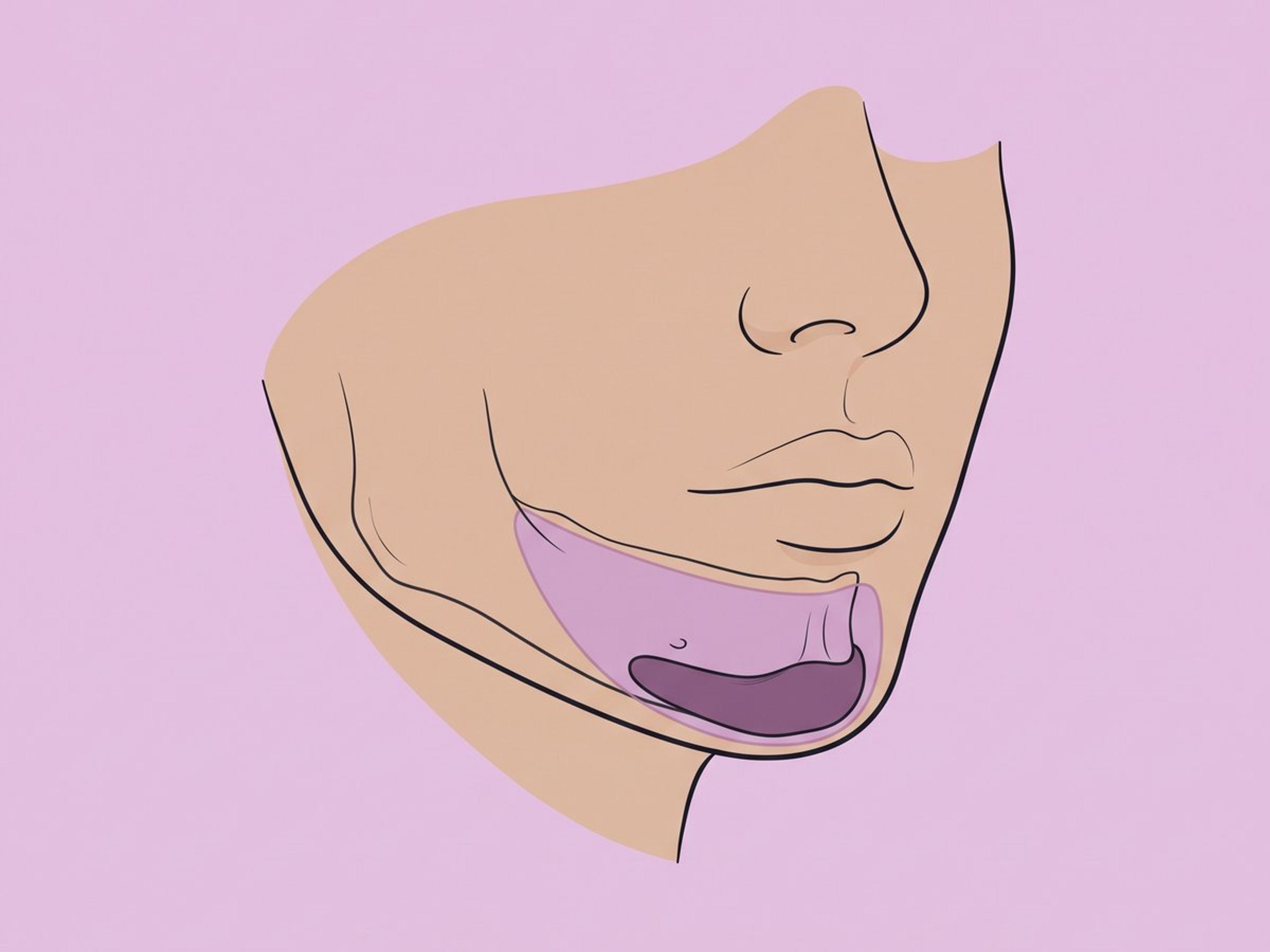 Intraoraler Zugang — illustration