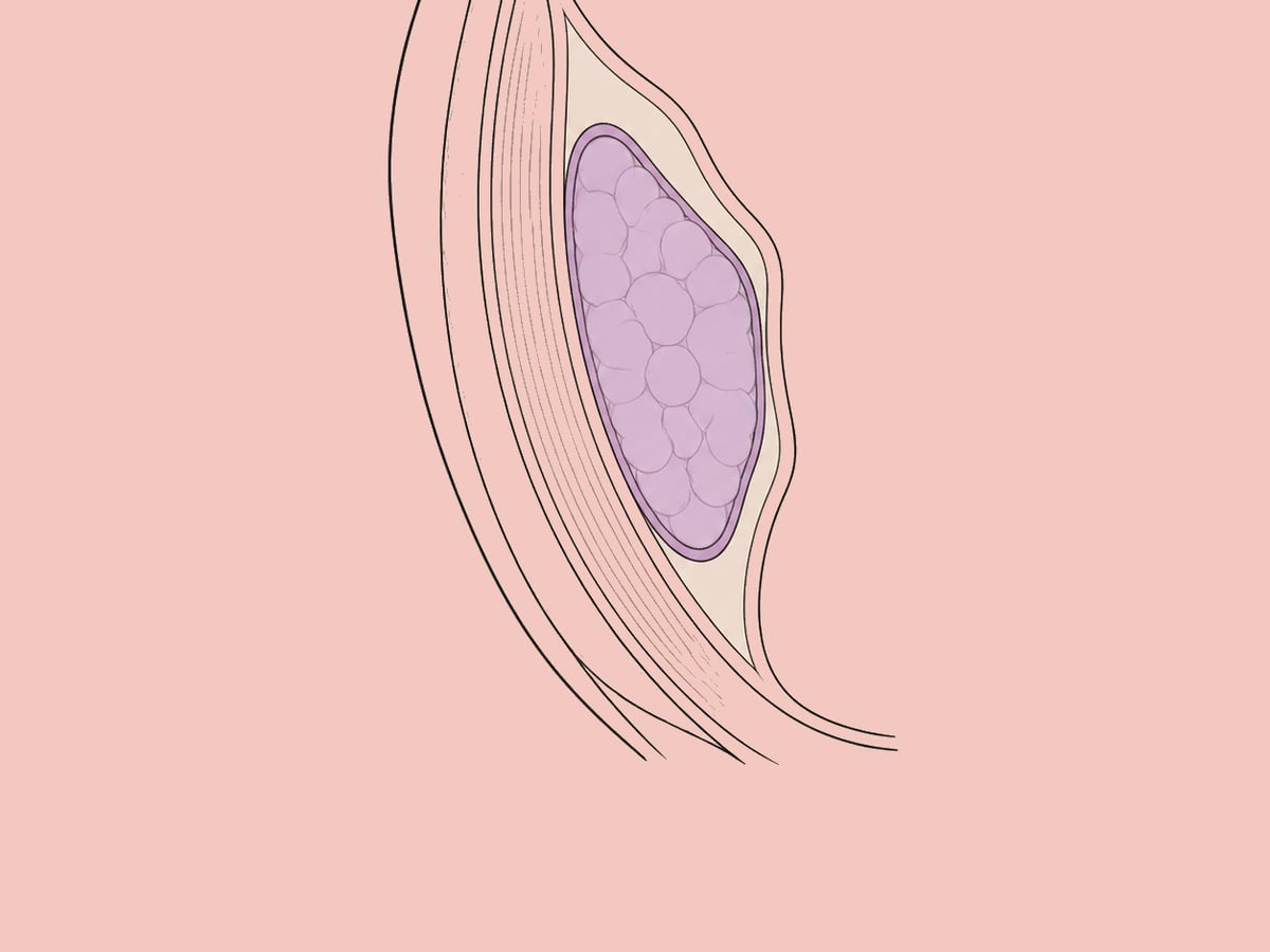 استئصال دهون الخد (إزالة دهون بوكا) — illustration