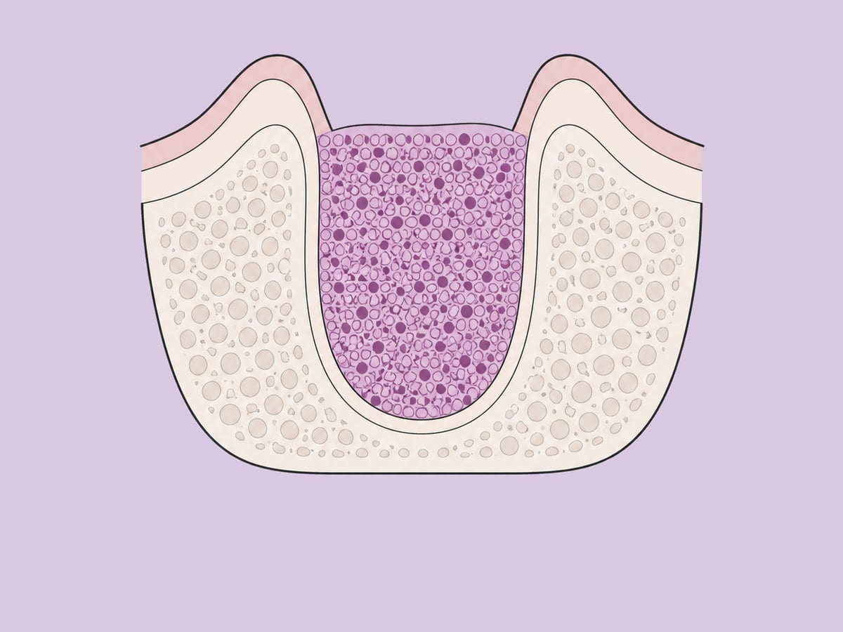 Greffe de préservation alvéolaire — illustration