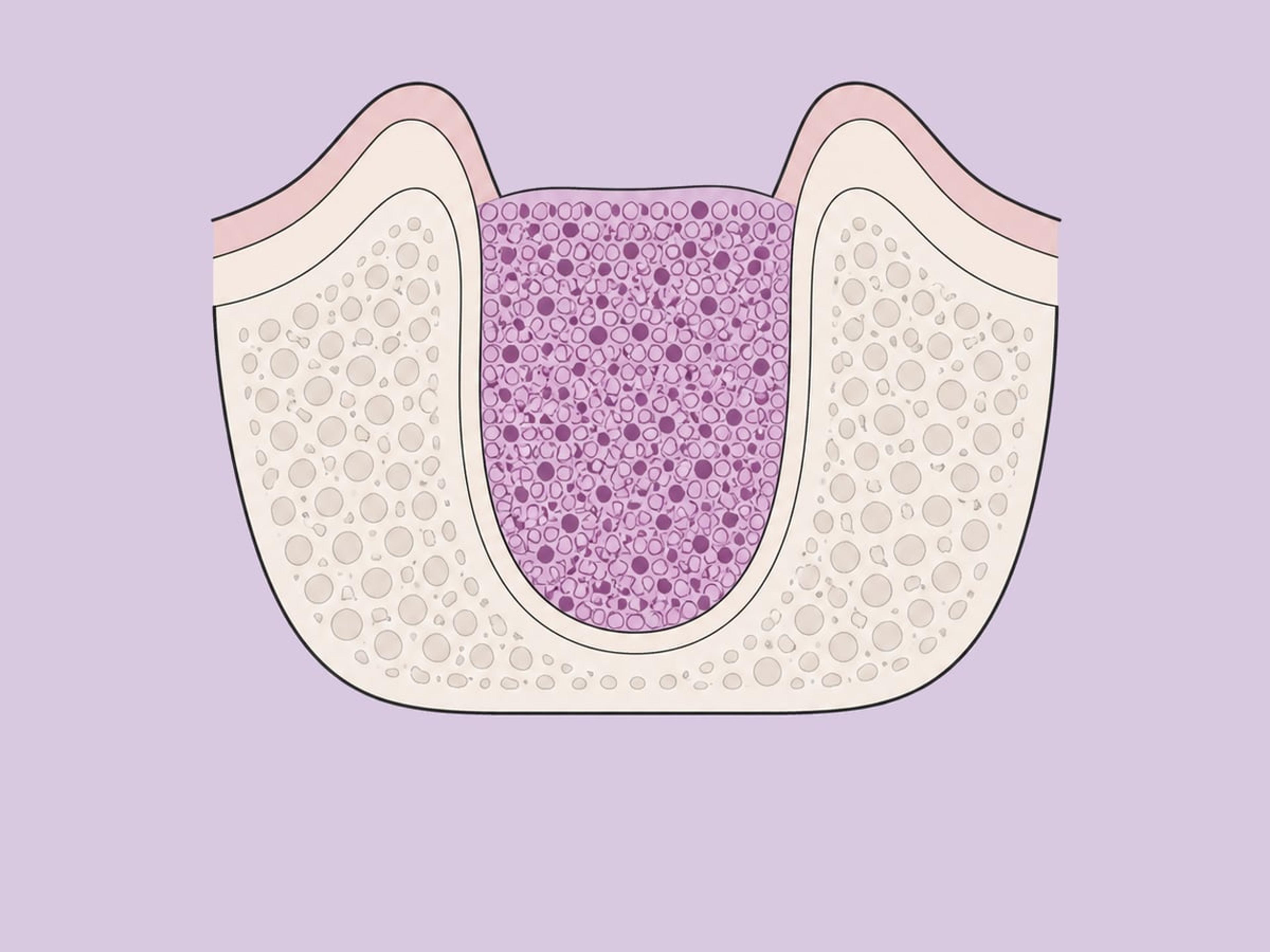 Socket preservation grafting — illustration
