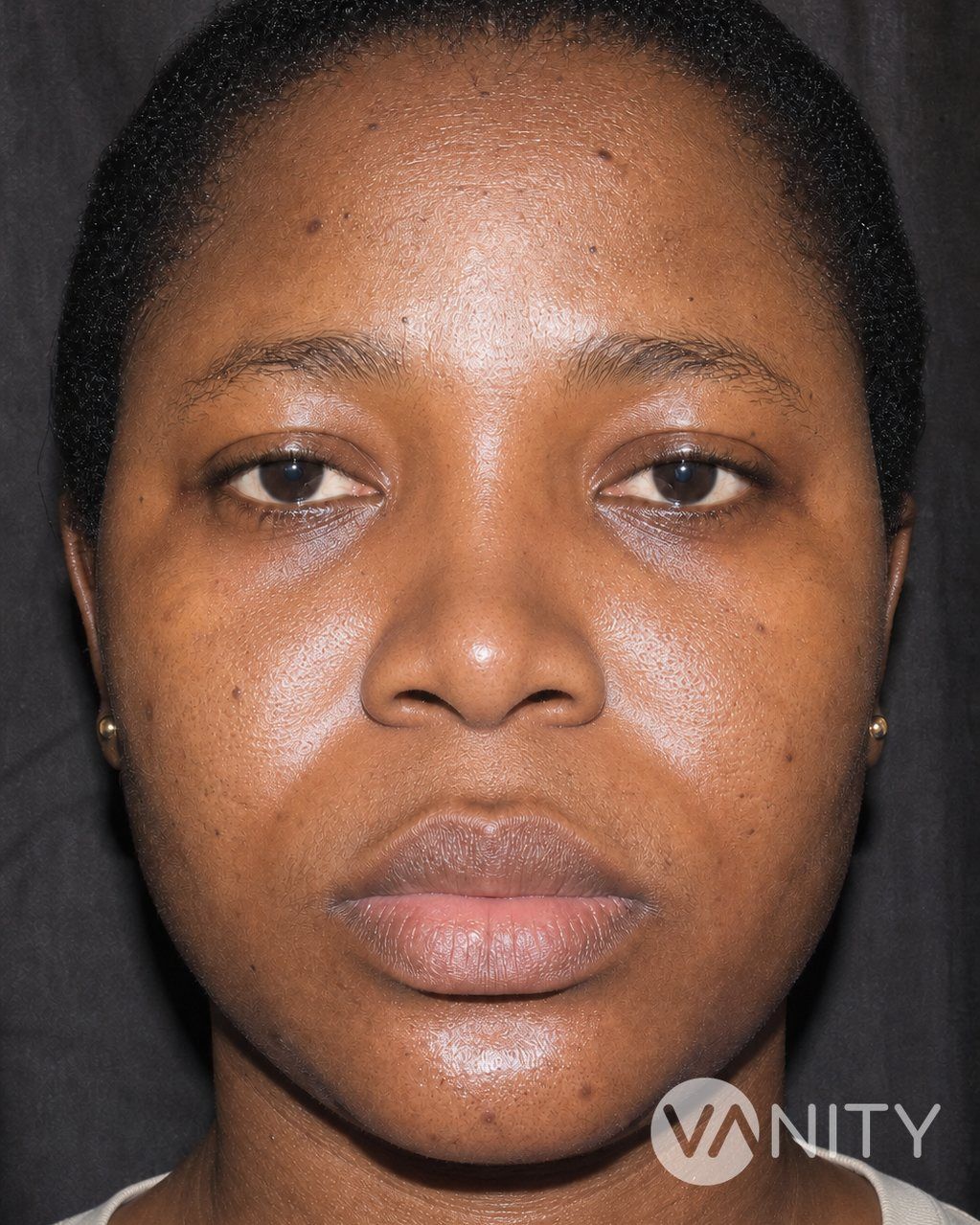 After Ethnic rhinoplasty — illustrative, not a real patient