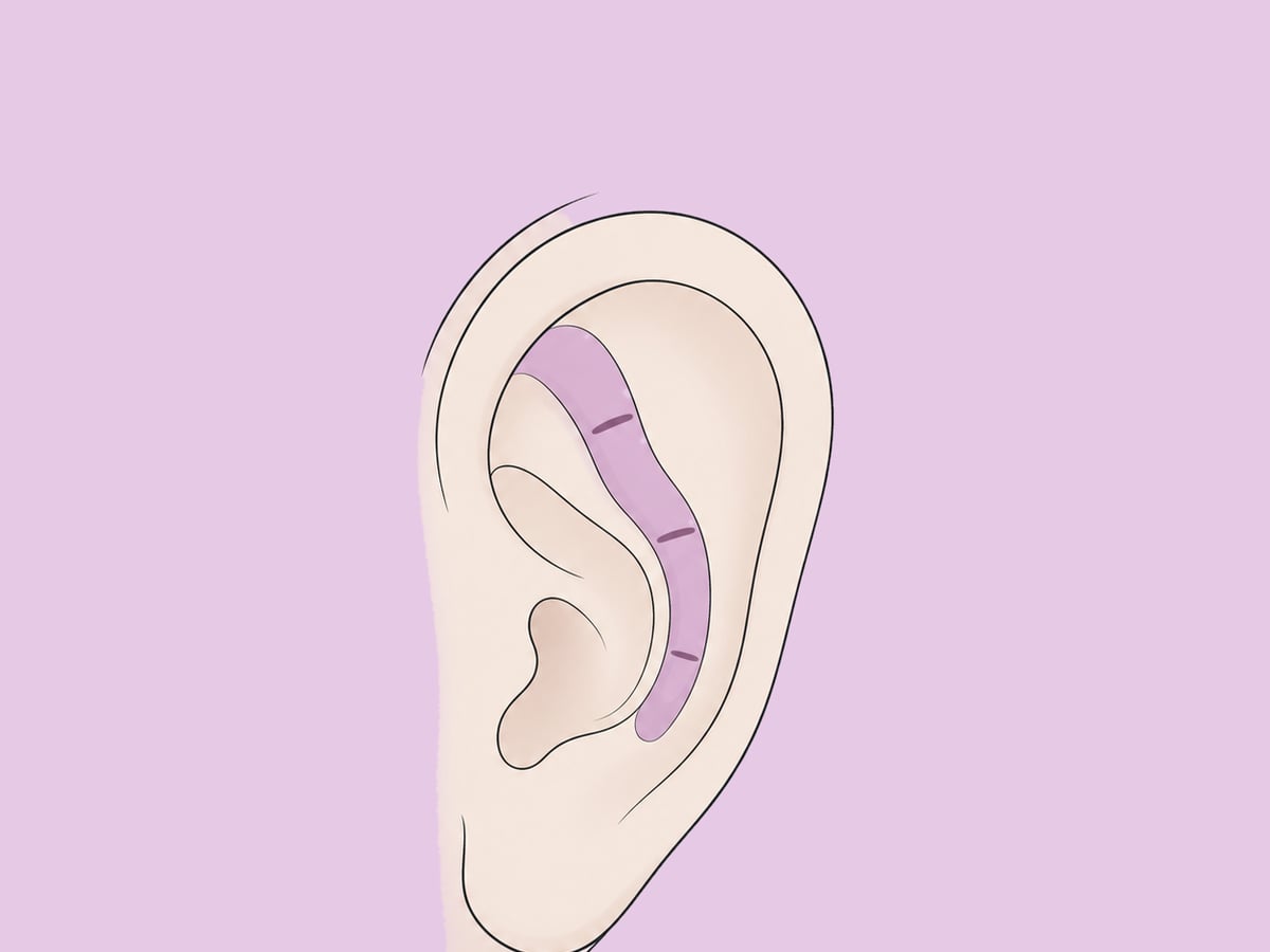Knorpelritzung (Schnitttechnik) — illustration