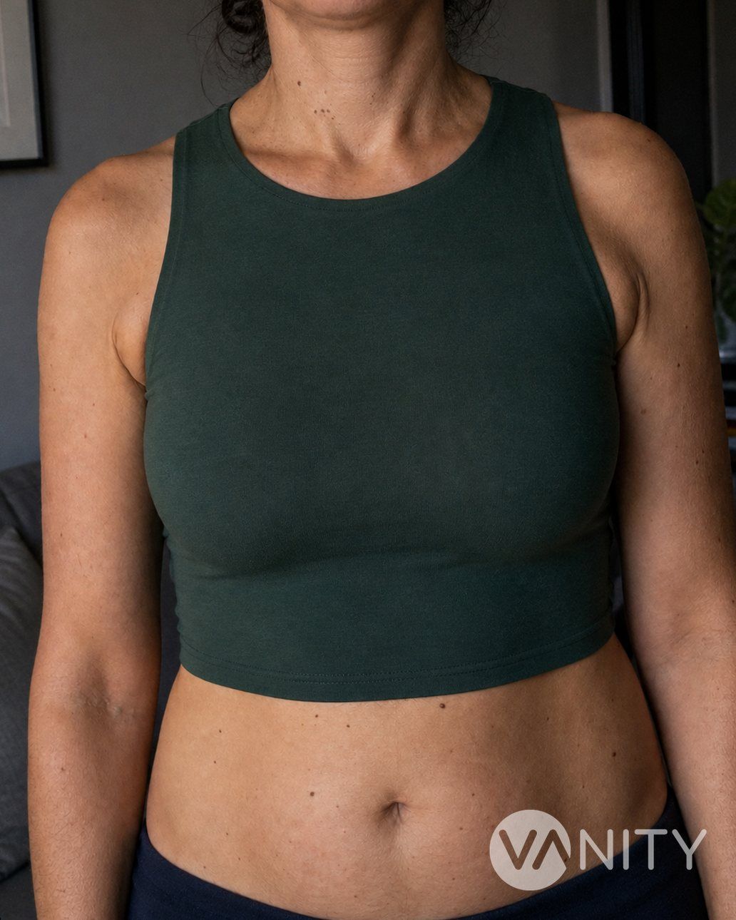 After Breast Implant Revision (Removal or Replacement) — illustrative, not a real patient