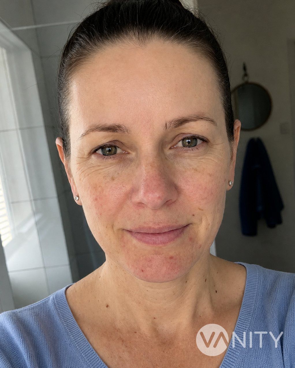 After Botox — illustrative, not a real patient