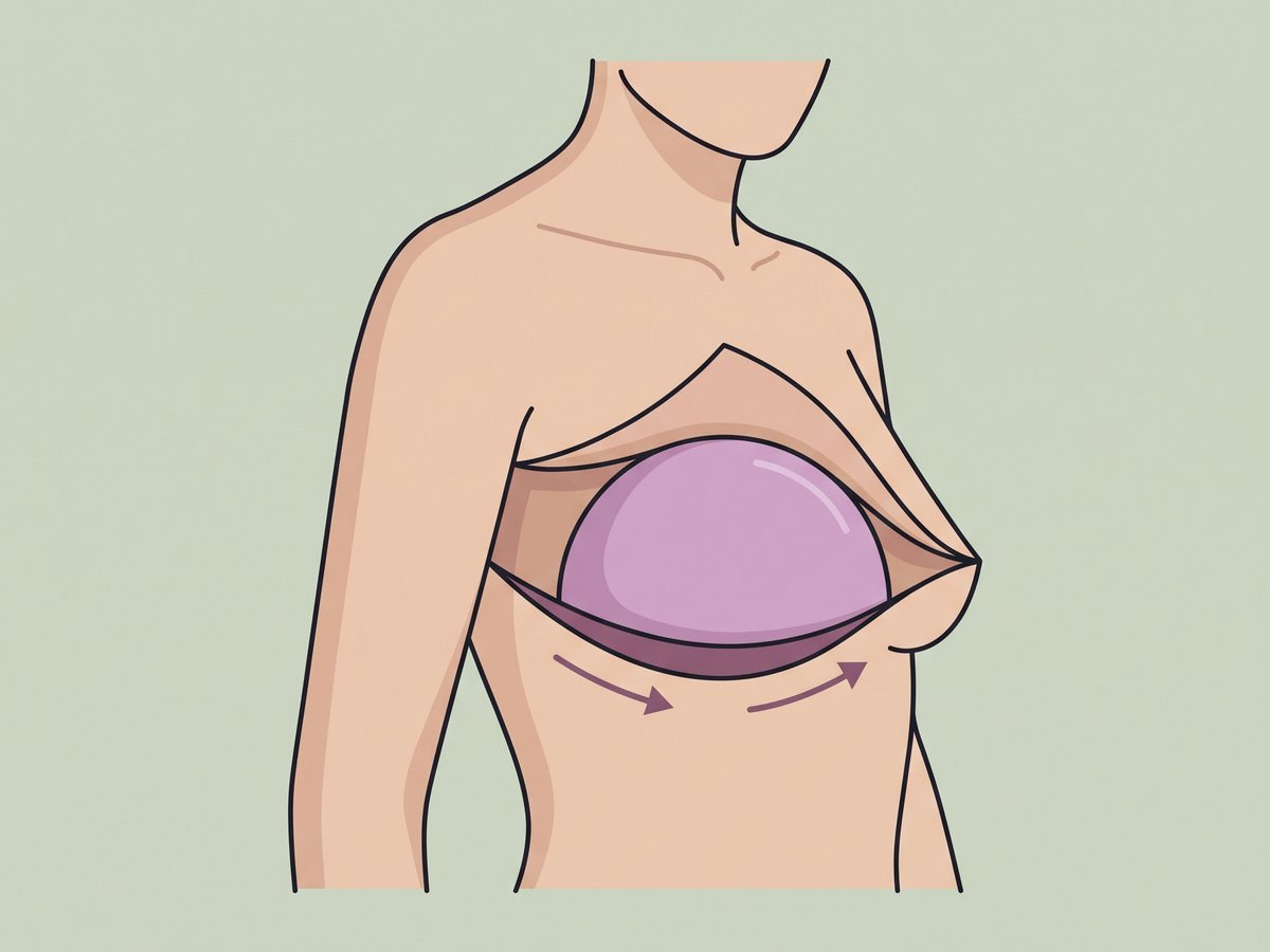 Tissue expansion and grafting — illustration