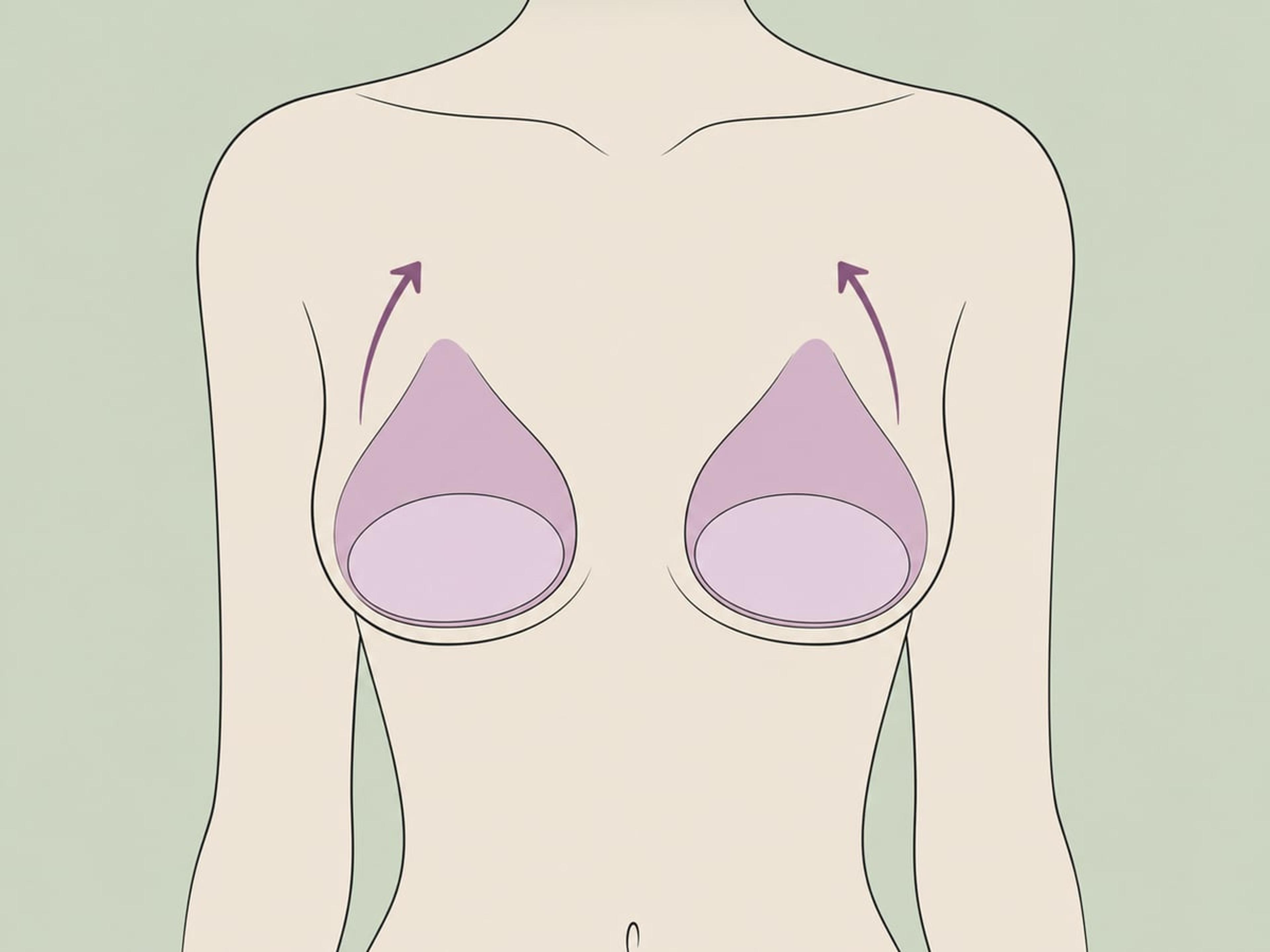 Bauchdeckenstraffung + Augmentationsmastopexie — illustration