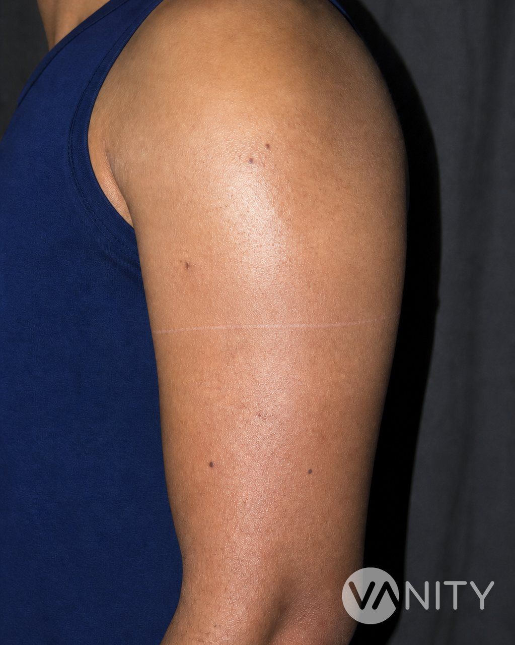 After Scar revision — illustrative, not a real patient