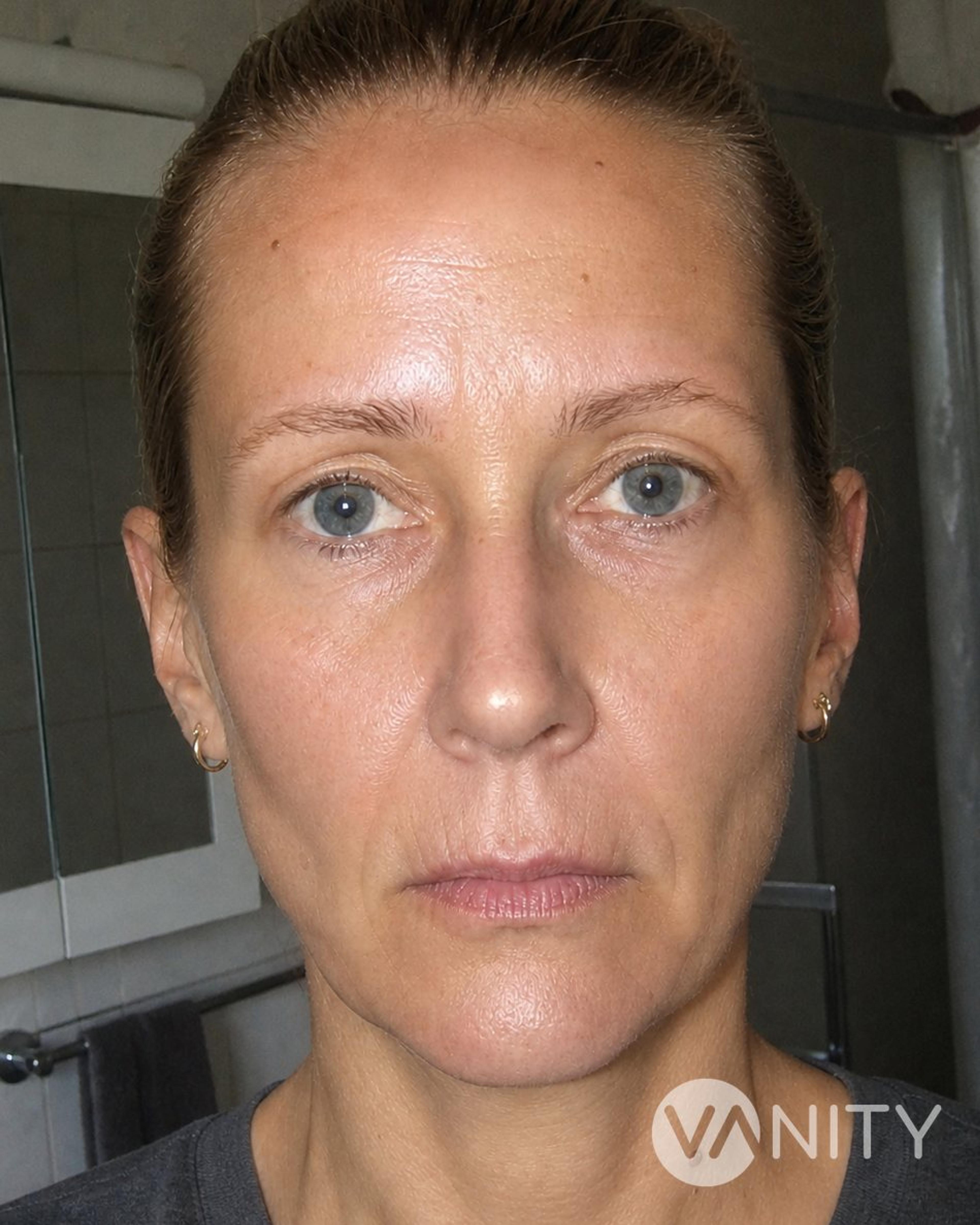 After Fat Transfer ( Lipofilling) — illustrative, not a real patient