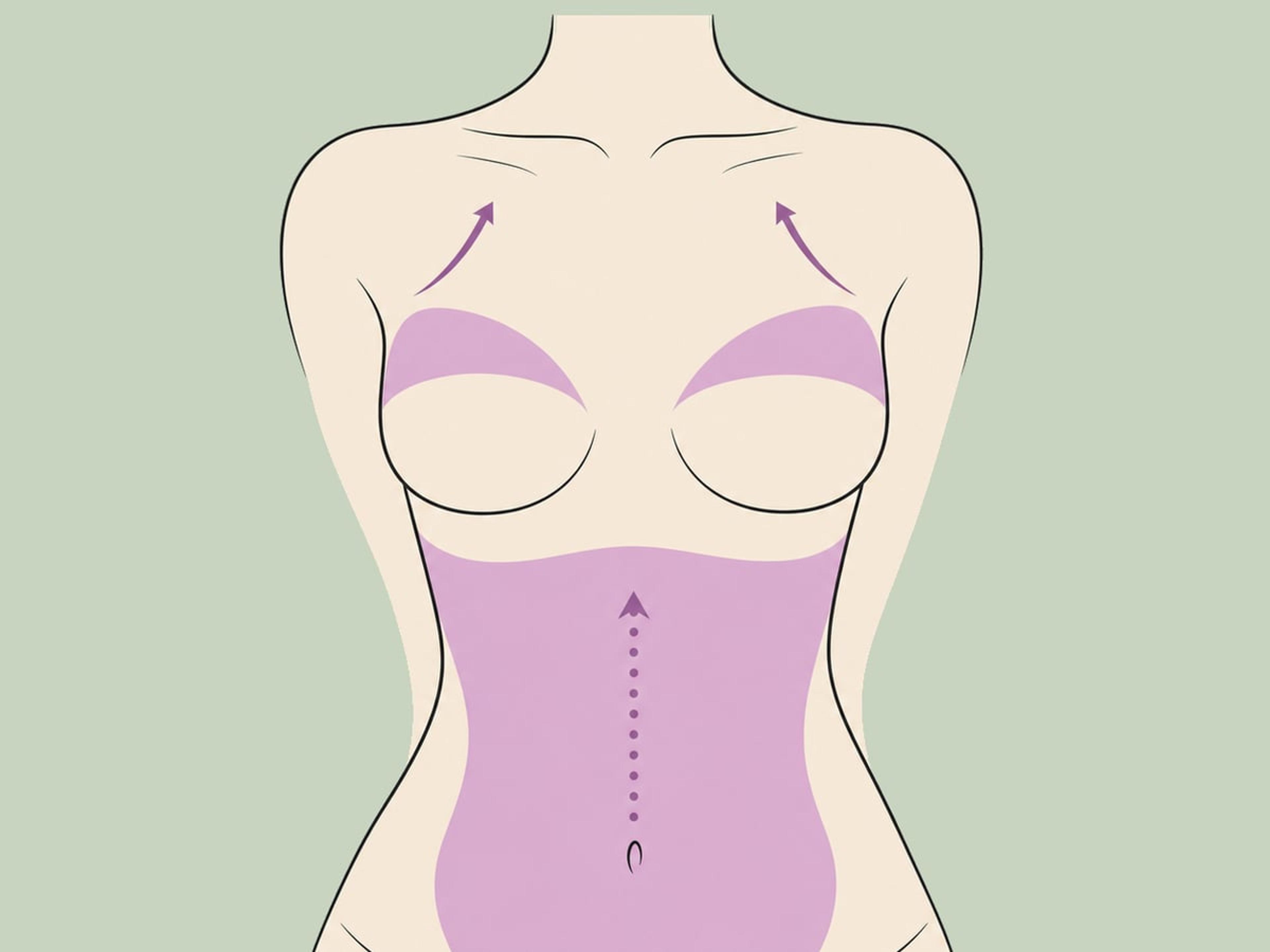 Bauchdeckenstraffung + Brustvergrößerung — illustration
